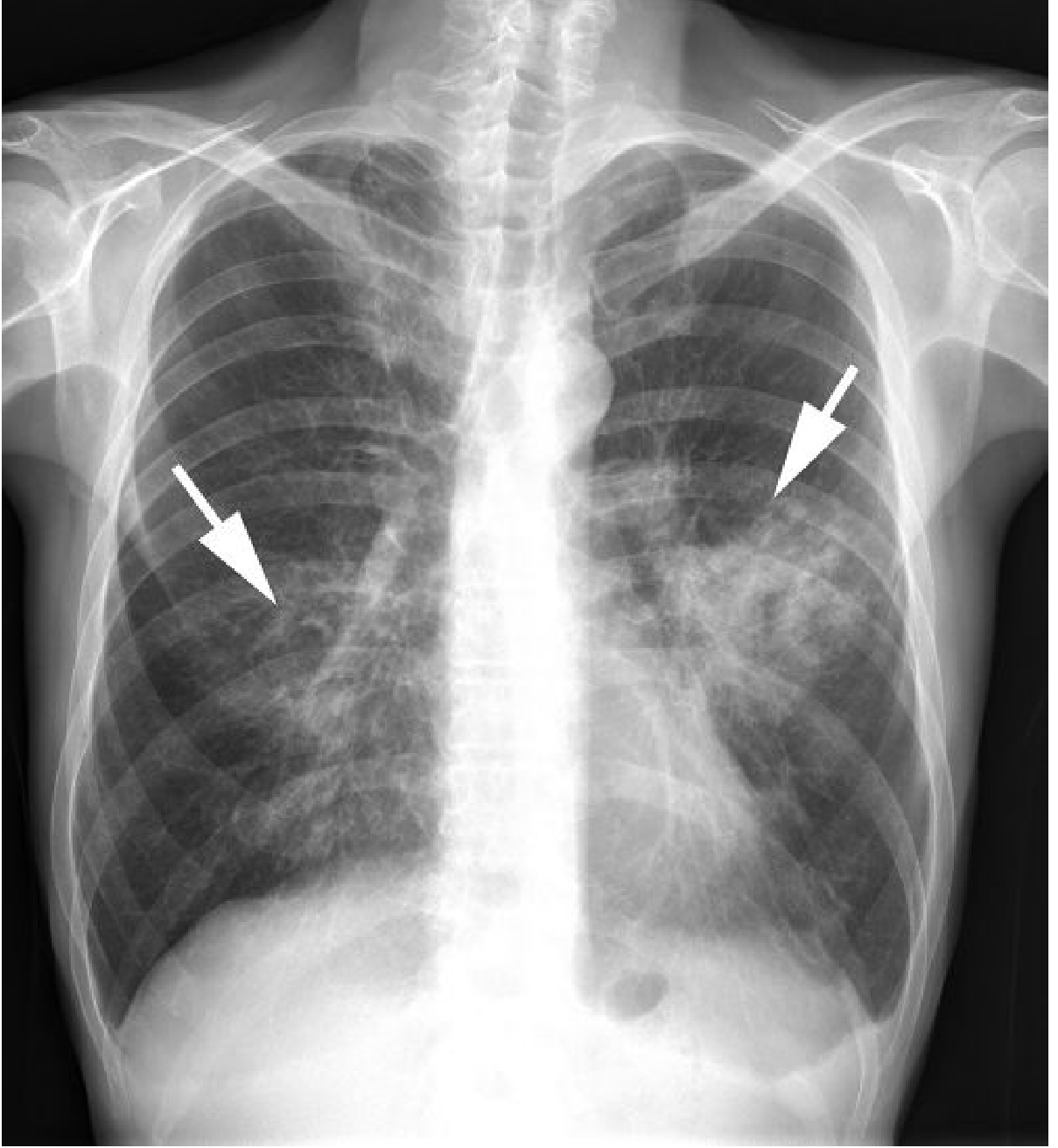 CXR showing bilateral ill-defined consolidations in H. influenzae pneumonia