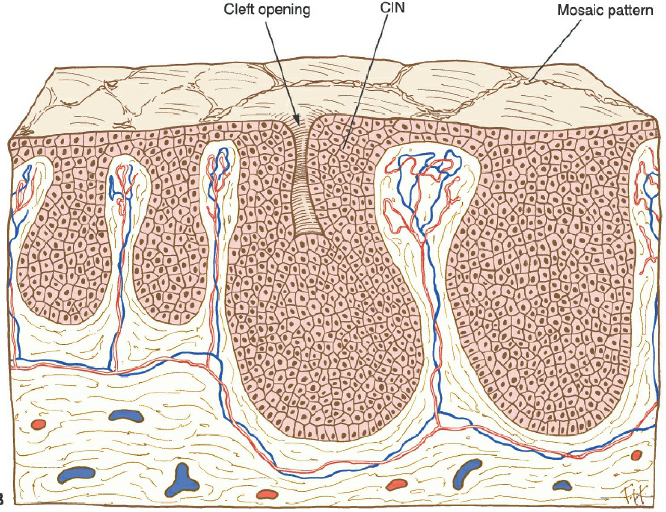 Mosaic pattern and punctation in CIN - Berek & Novak Fig 16-11