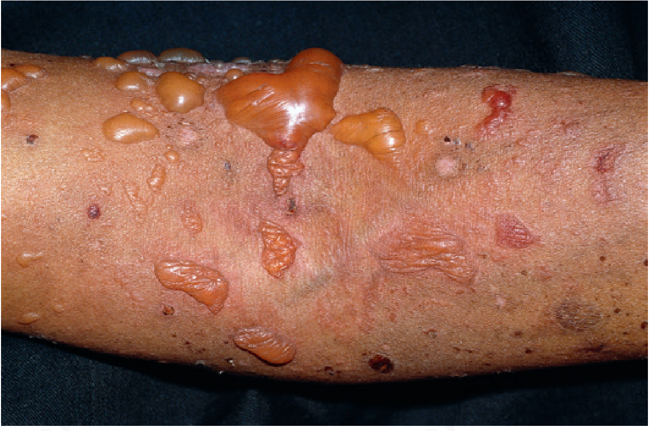 Bullous lupus erythematosus - tense bullae and vesicles on the arm