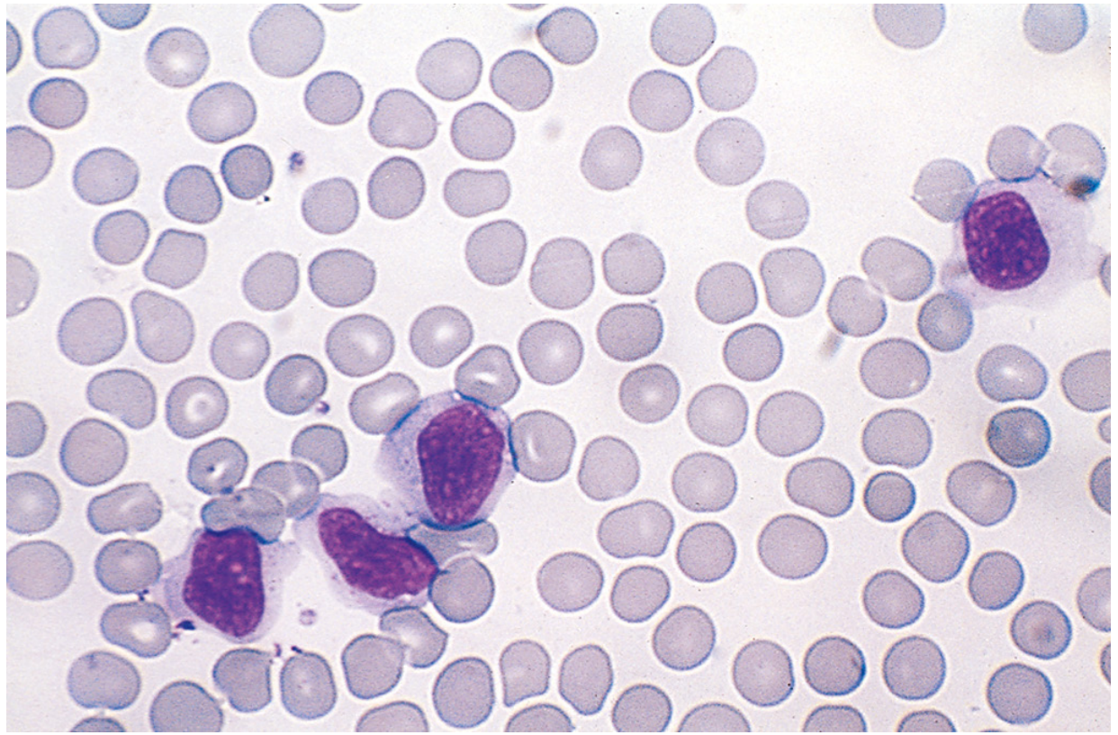 Atypical lymphocytes in infectious mononucleosis - large cells with abundant pale cytoplasm, folded nuclei, contrasting with surrounding RBCs