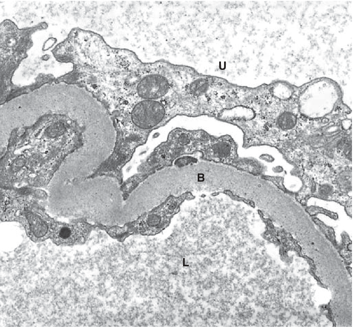 Electron micrograph: Thickened GBM in diabetic nephropathy - U = urinary space, B = basement membrane, L = capillary lumen
