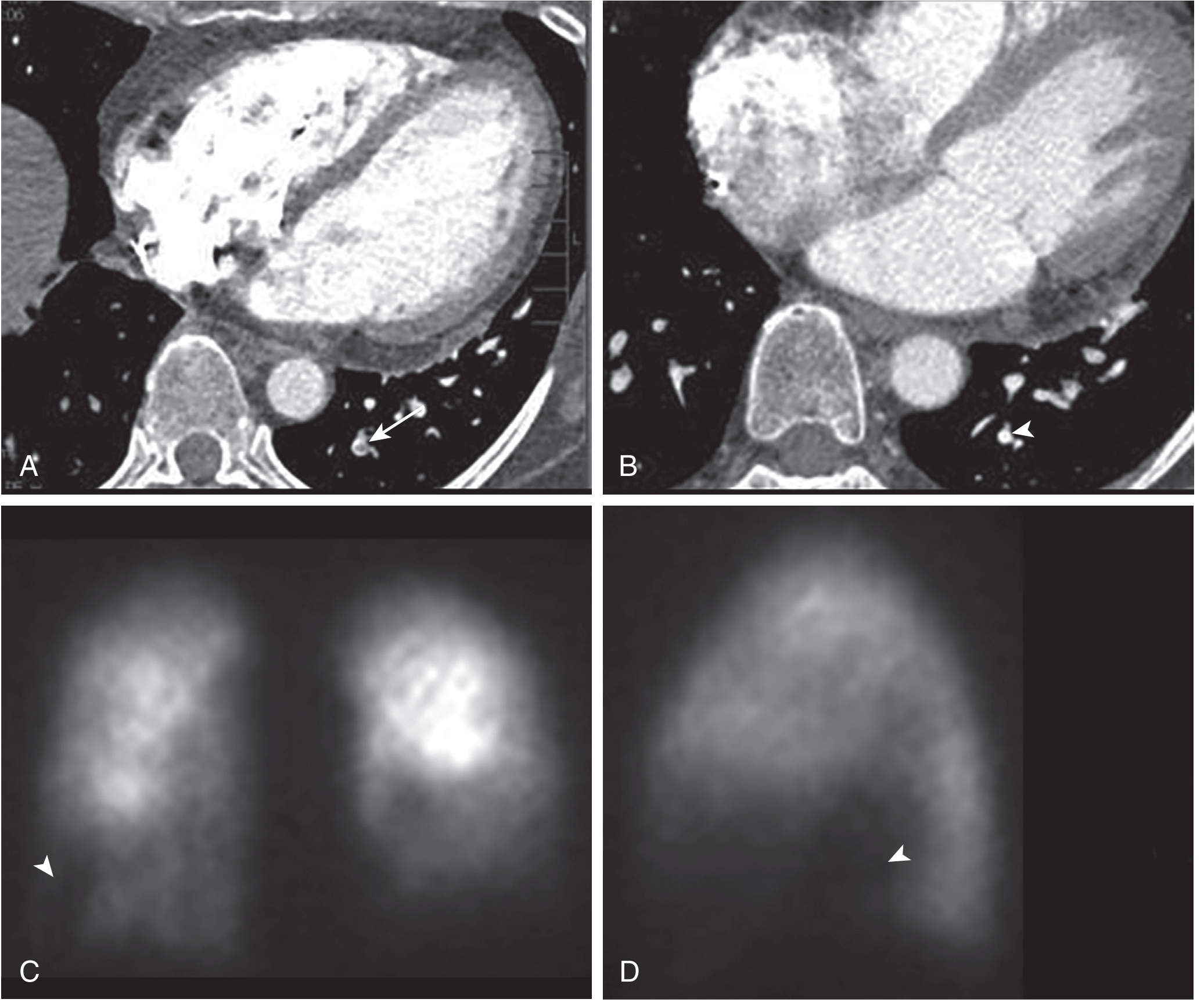 Solitary subsegmental PE on CTPA with V/Q scintigraphy correlation