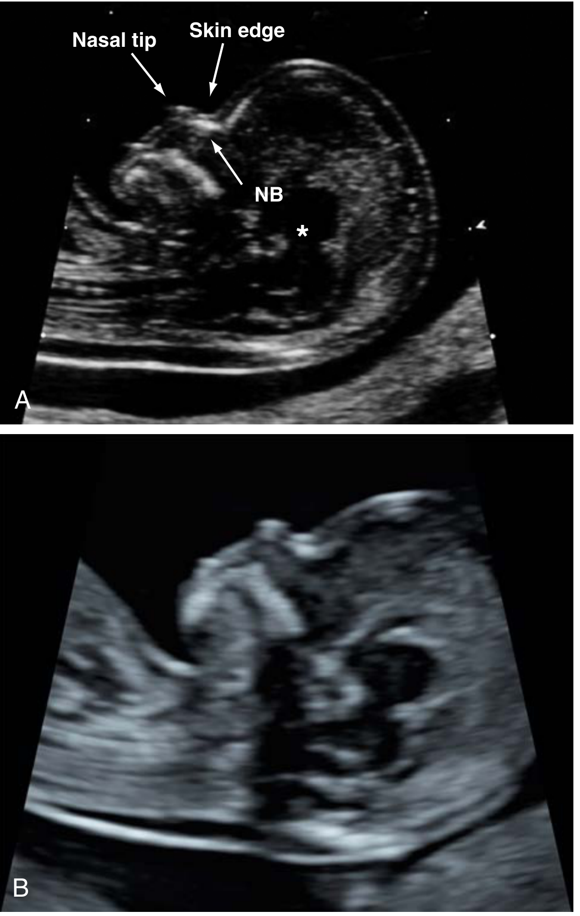 Nasal bone ultrasound - midsagittal profile showing NB landmark (A) and absent NB in a Black-race fetus (B)