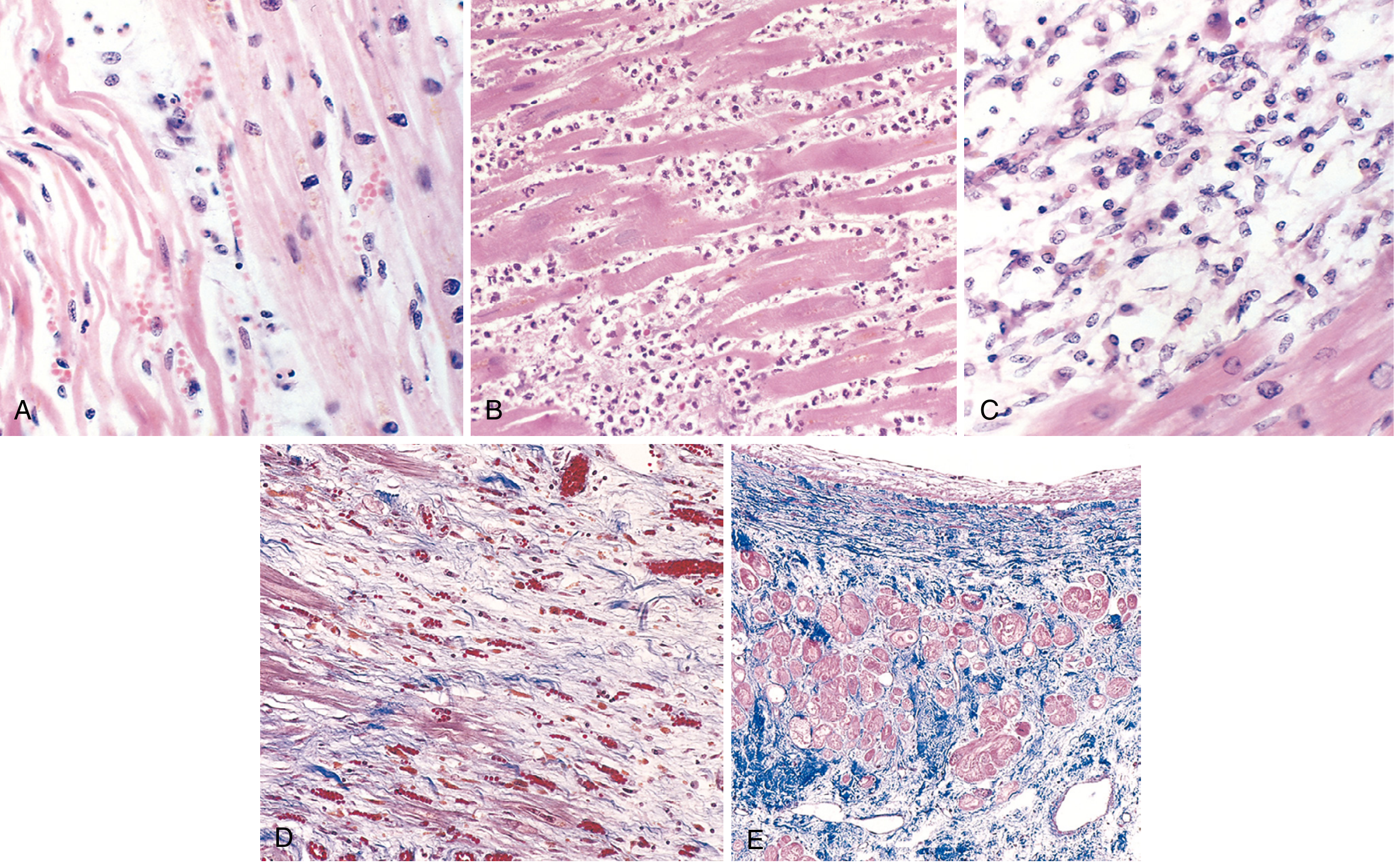 Microscopic features of MI at different stages: A=wavy fibers+coagulative necrosis; B=PMN infiltration day 3-4; C=macrophage phagocytosis day 7-10; D=granulation tissue; E=healed scar with blue collagen (Masson trichrome)