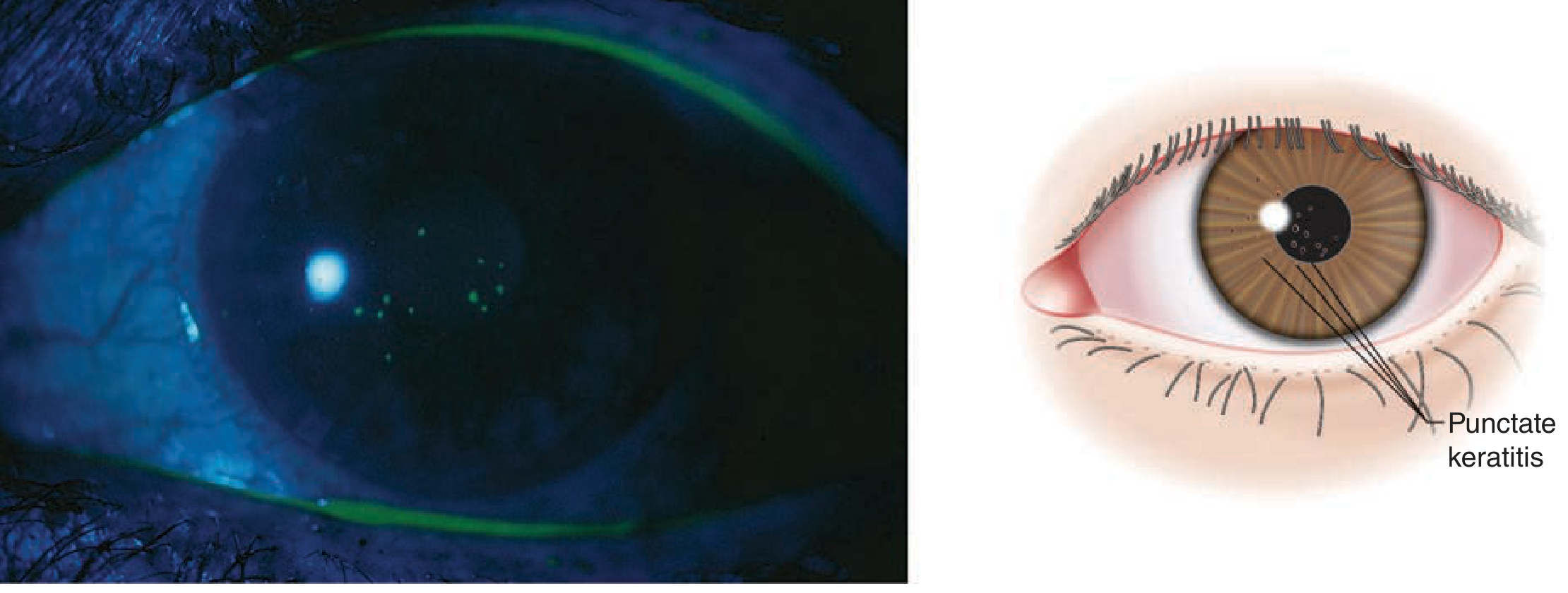 Fluorescein staining showing punctate keratitis (left: clinical; right: diagram showing punctate corneal epithelial defects)