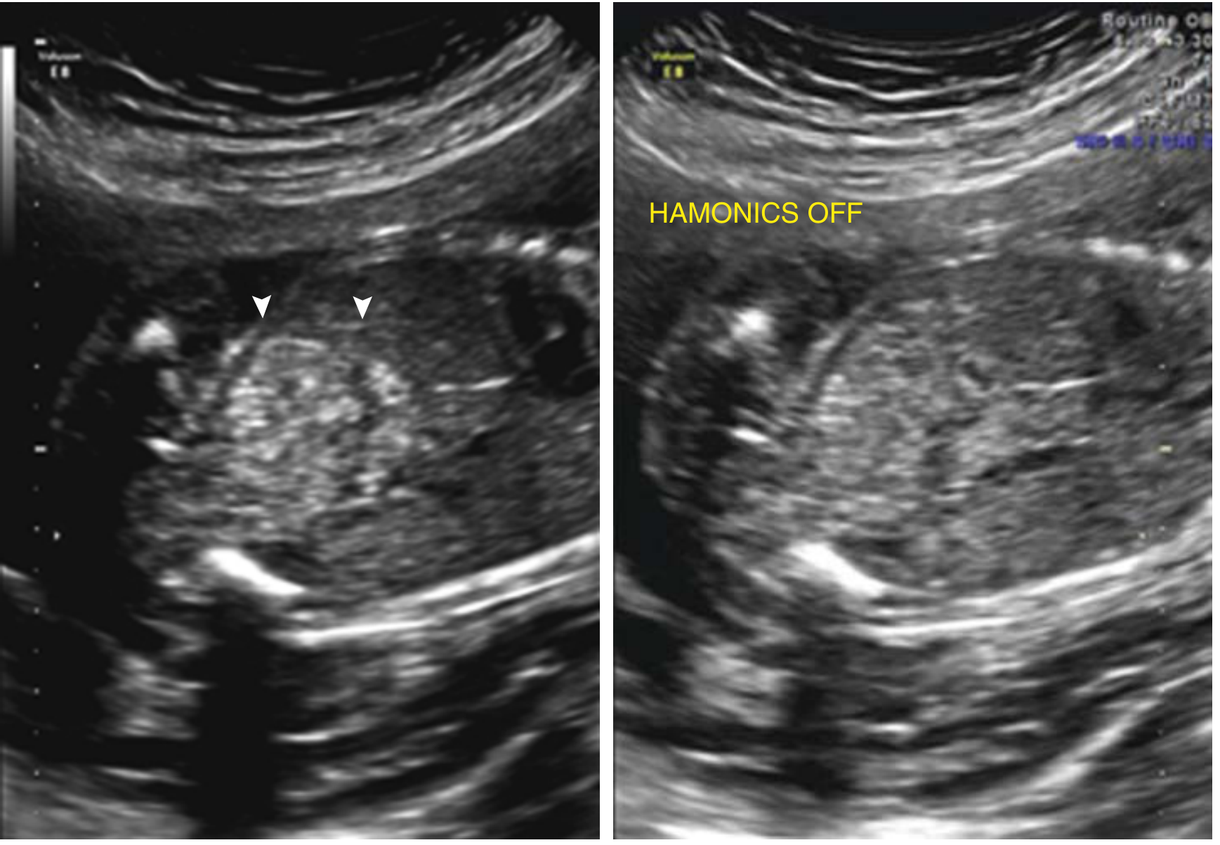 Harmonic imaging effect - bowel appears echogenic with harmonics on (arrowheads, left), but normal with harmonics off (right)