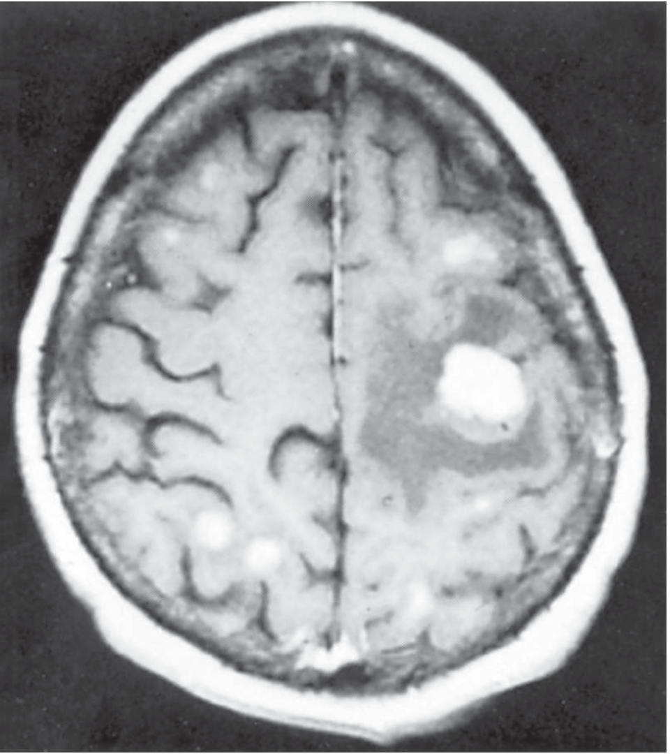 Multiple enhancing brain metastases from breast carcinoma on T1-weighted gadolinium MRI - note bright ring-enhancing lesions at grey-white junction with surrounding edema