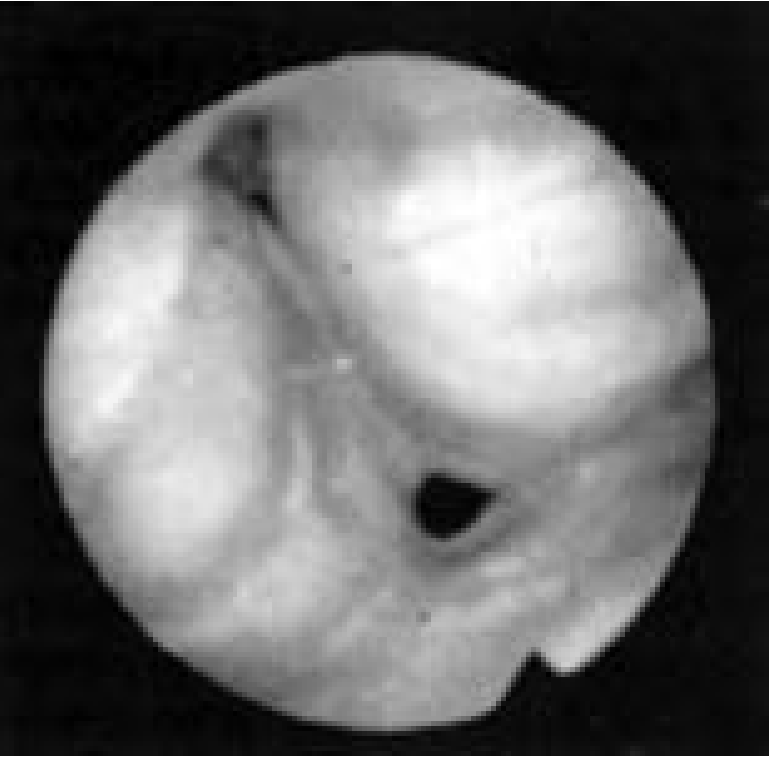 Fiberoptic view of hypopharyngeal collapse during Muller maneuver