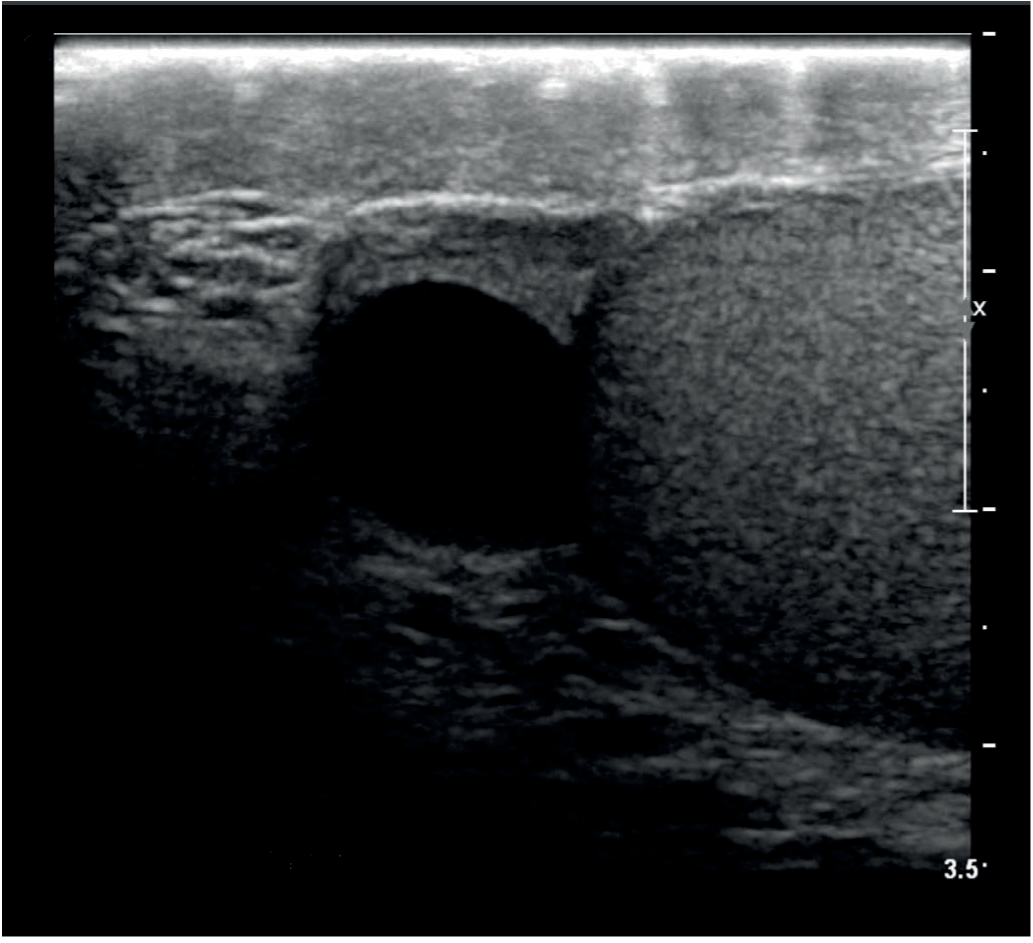 Ultrasound image of an epididymal cyst showing a well-defined anechoic (dark) circular structure
