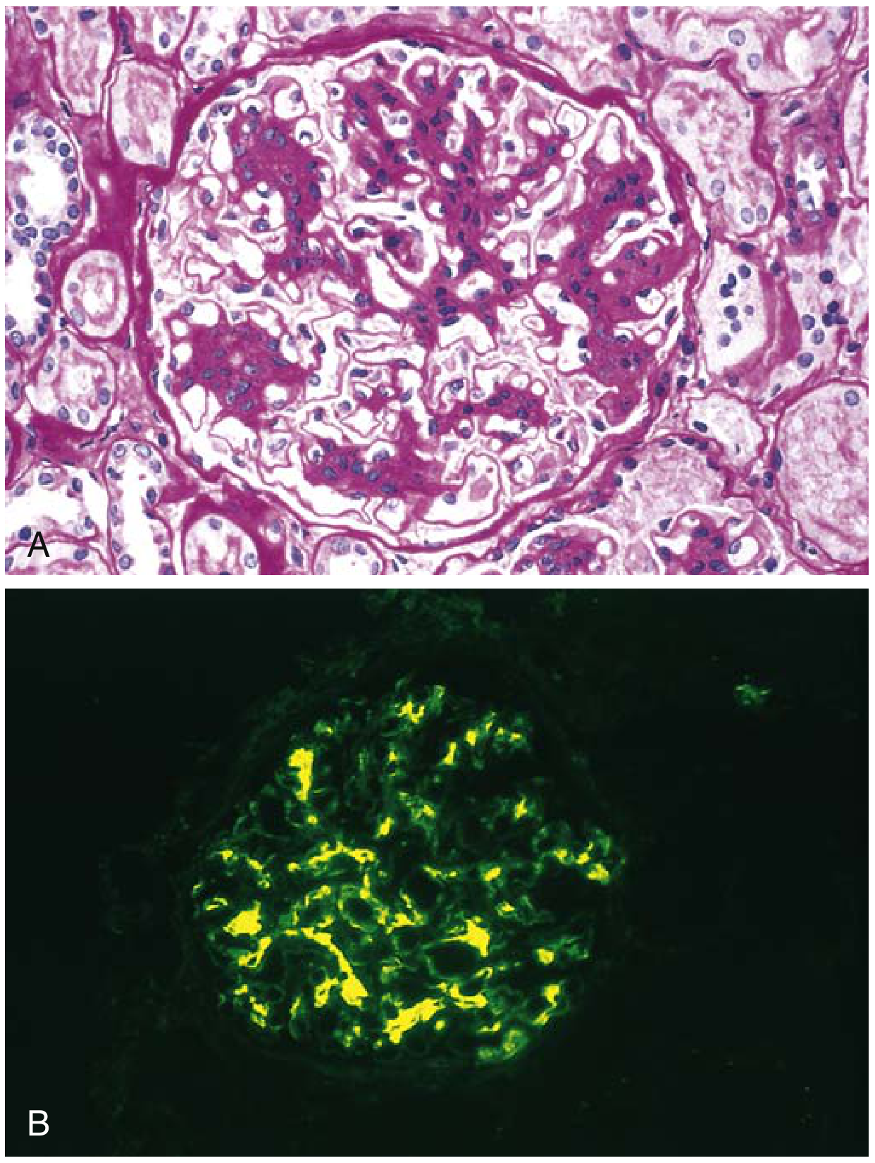 IgA nephropathy - (A) Light microscopy showing mesangial proliferation and matrix increase; (B) characteristic mesangial IgA deposition on immunofluorescence (yellow/bright green)