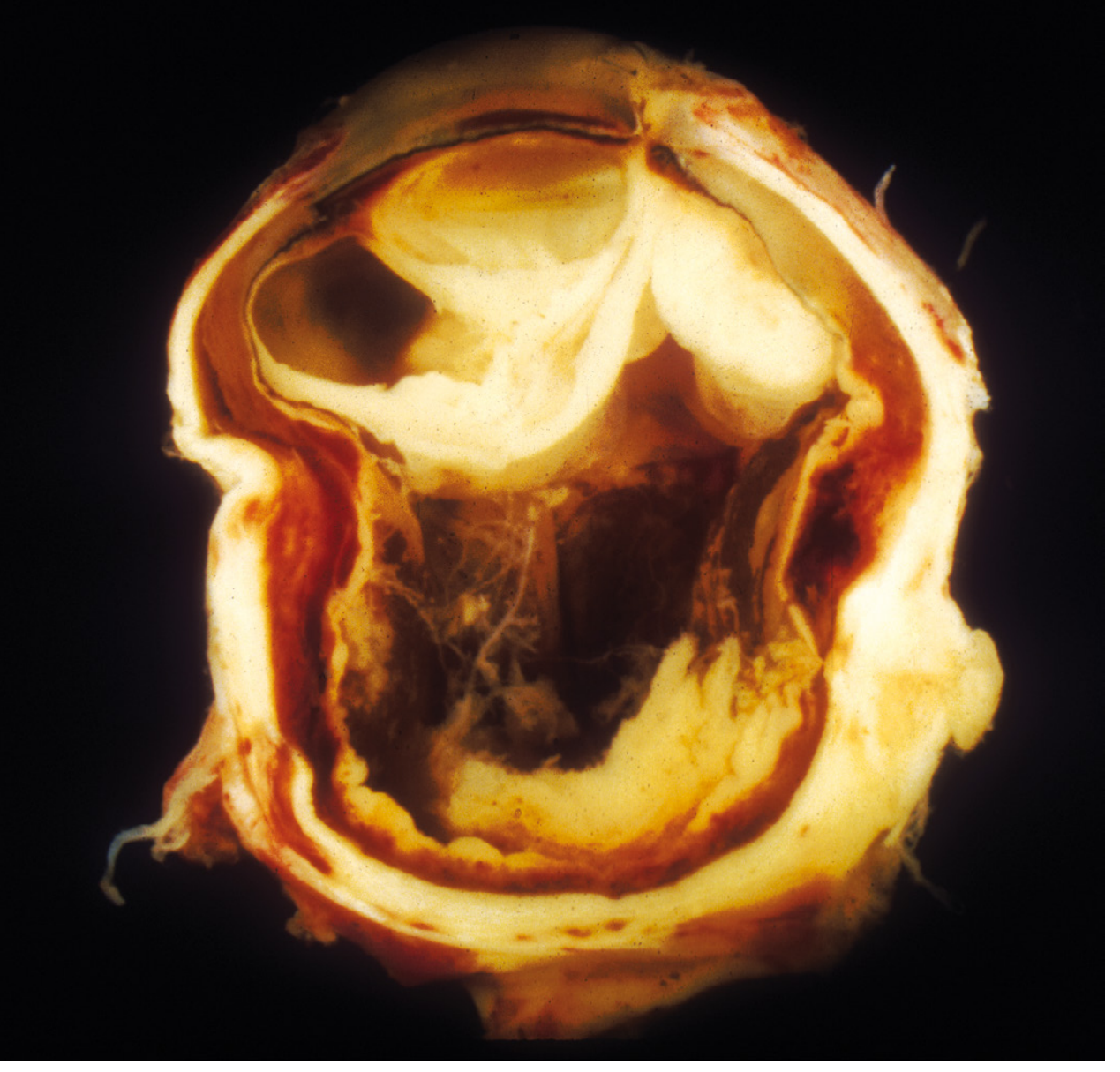 Gross pathology of exogenous panophthalmitis - eye removed after foreign body injury showing suppurative inflammation distorting entire ocular architecture