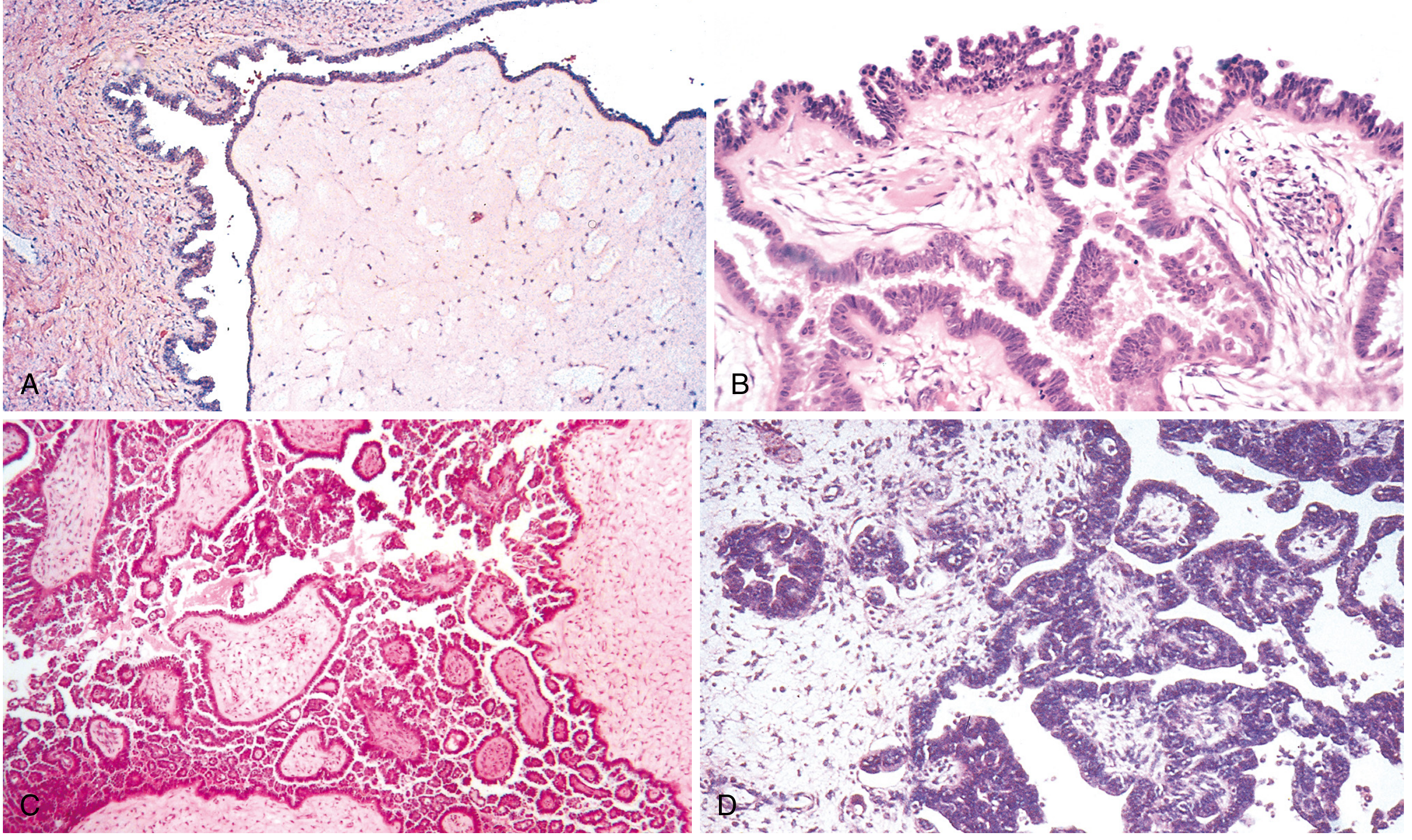 Microscopic appearances of serous tumors: (A) cystadenoma, (B) borderline, (C) low-grade micropapillary carcinoma, (D) high-grade serous carcinoma