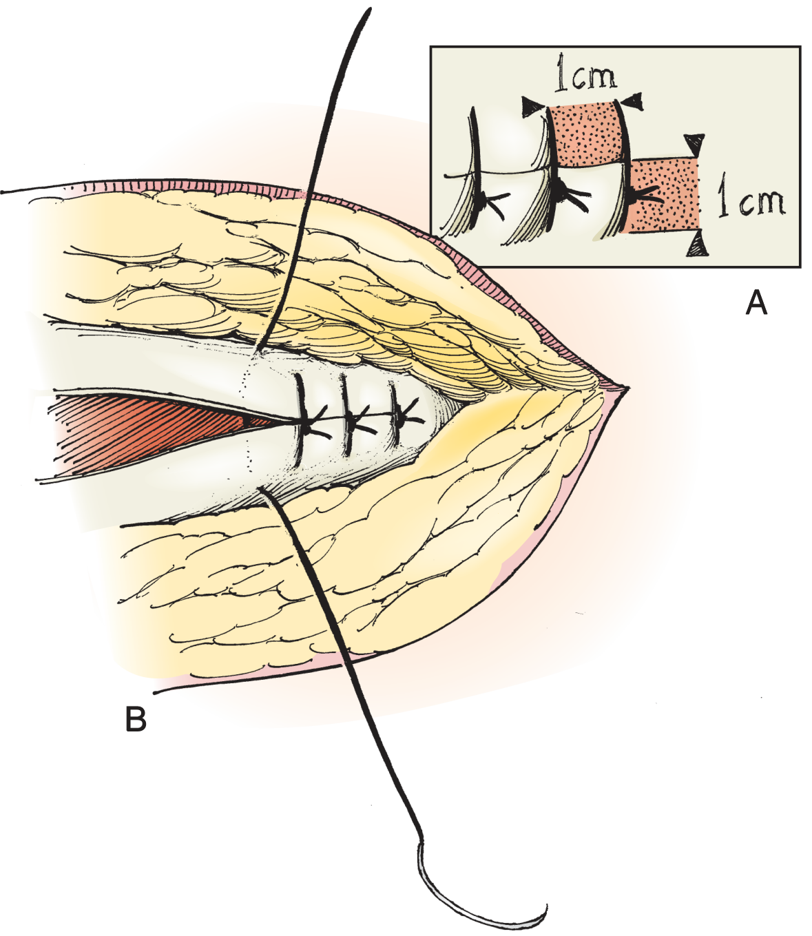 Lembert suture and mass closure technique from Hinman's Atlas of Urologic Surgery - showing interrupted sutures approximating bowel wall layers