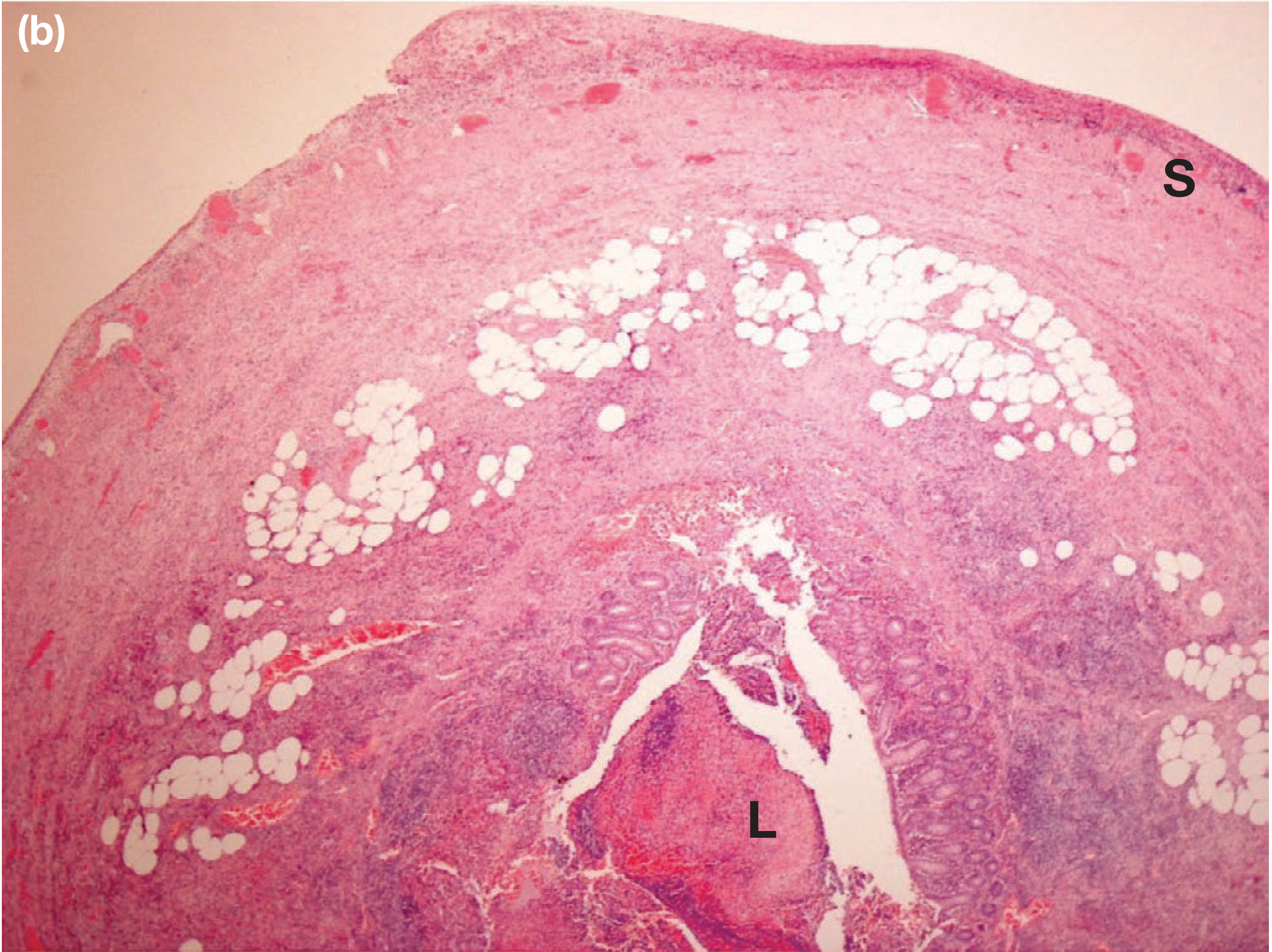 Acute appendicitis histology - pus-filled lumen (L) with inflammation extending to the serosa (S)
