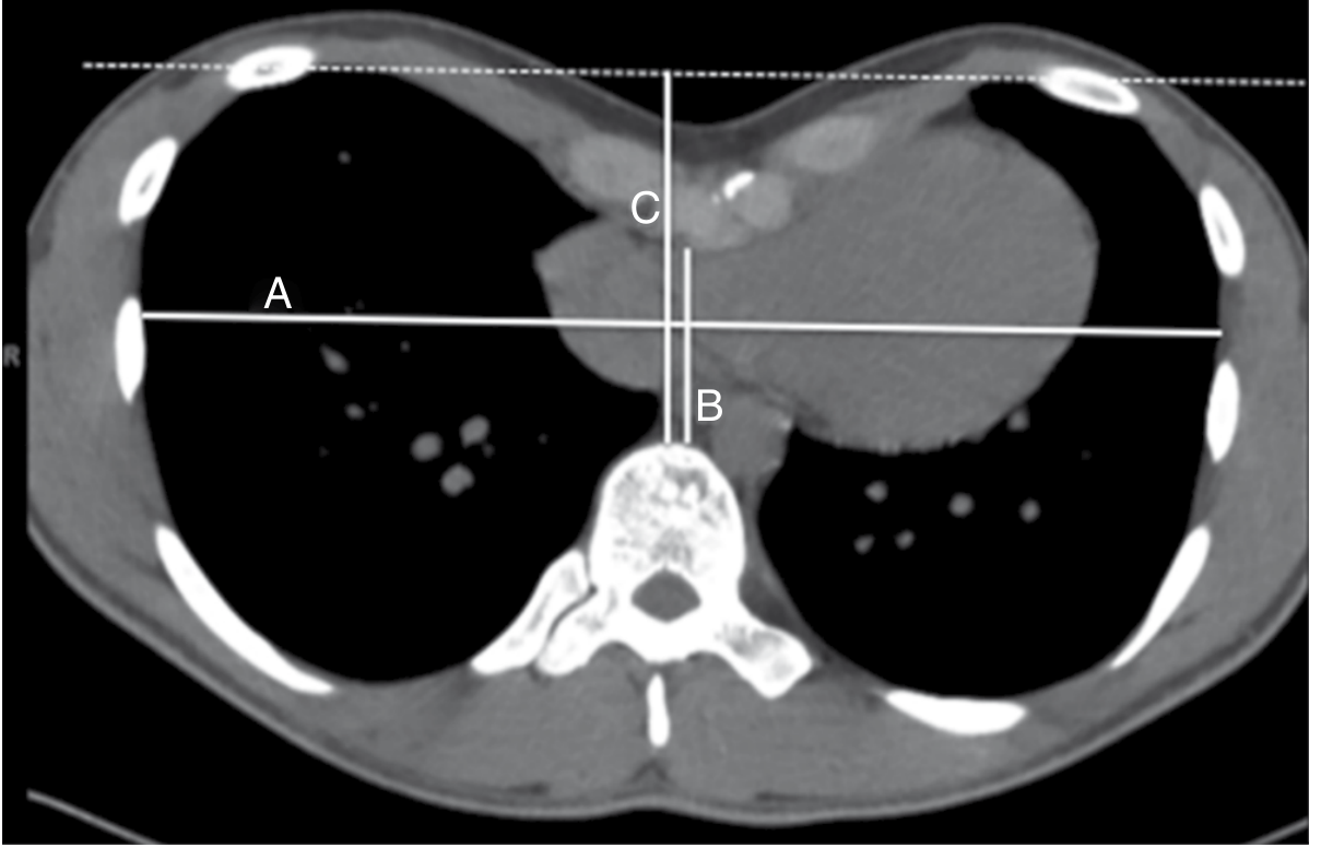 CT scan diagram showing Haller Index measurement - A and B lines
