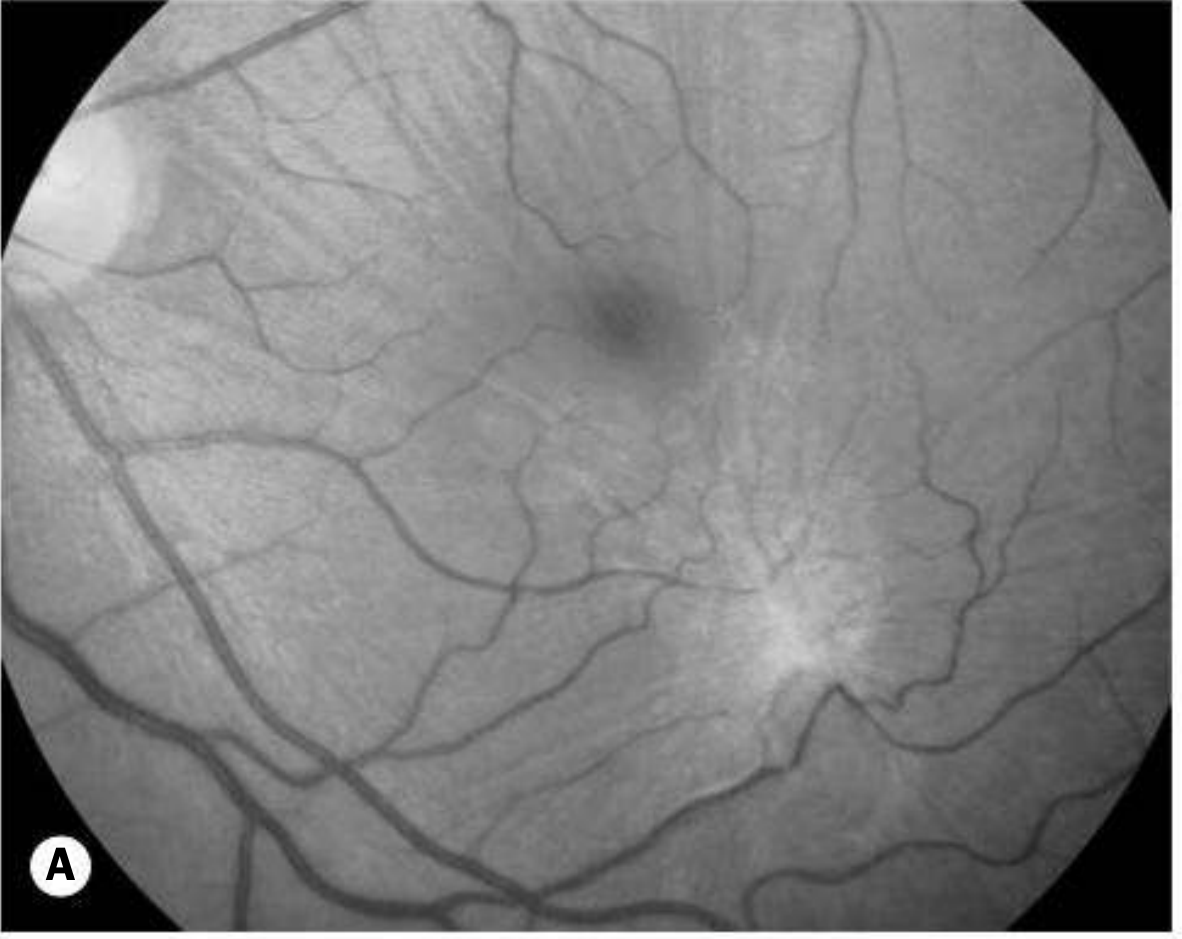 Fundus photo showing macular hole - Kanski