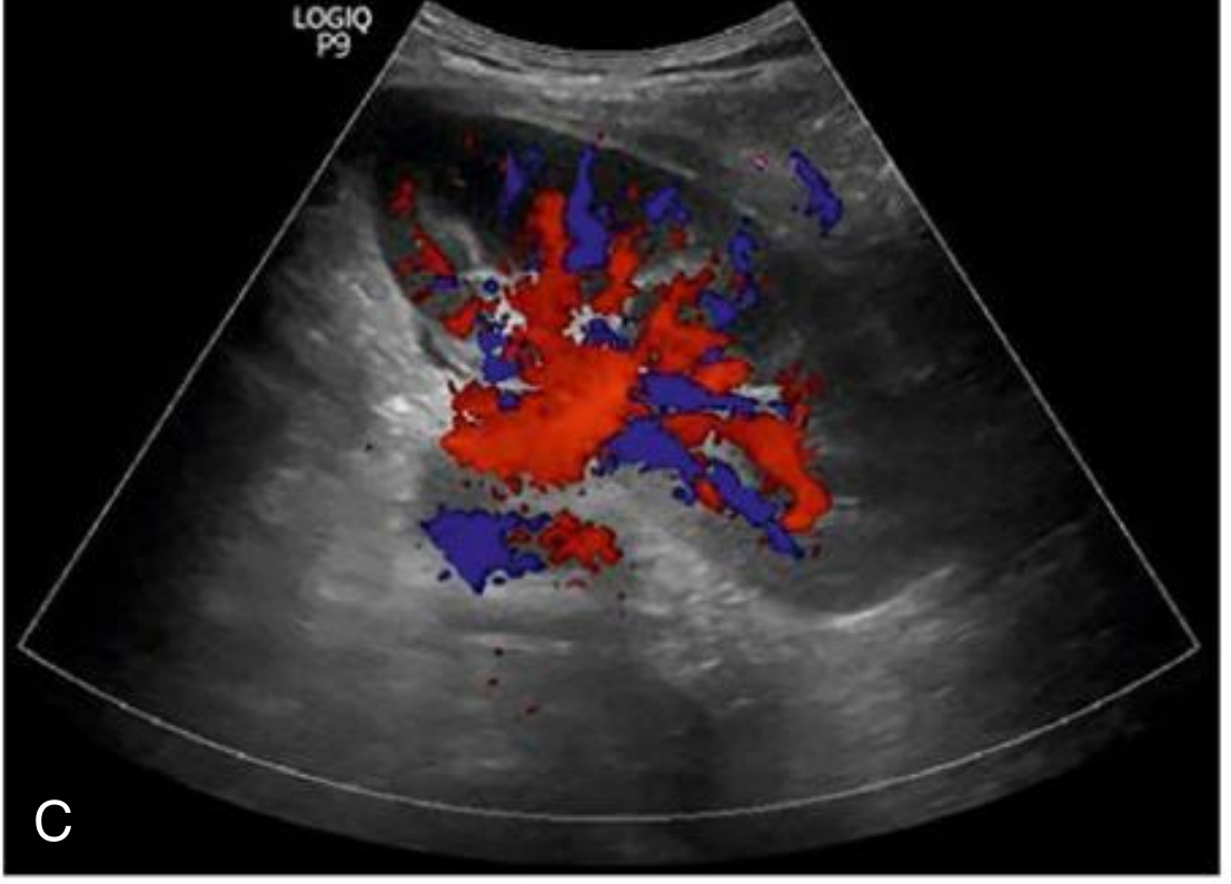 Color Doppler of a transplanted kidney showing red and blue flow in renal vasculature