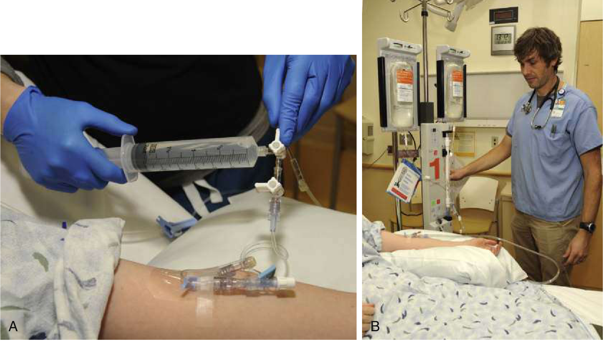 Push-pull syringe technique (A) and pressure bag technique (B) for delivering rapid fluid boluses