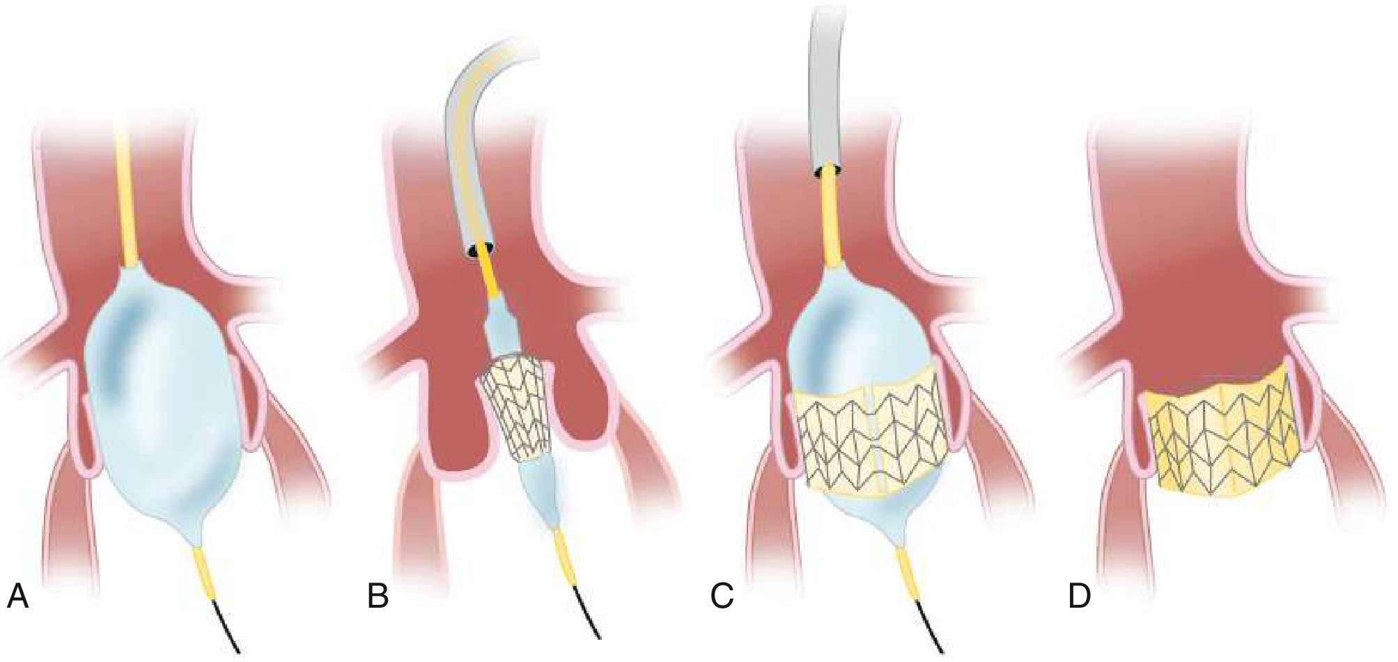 Four-panel TAVI deployment sequence - A: balloon dilation of native stenotic valve; B: crimped stented valve inserted over guidewire into annulus; C: balloon inflation deploys valve; D: balloon deflated and removed with new valve in place