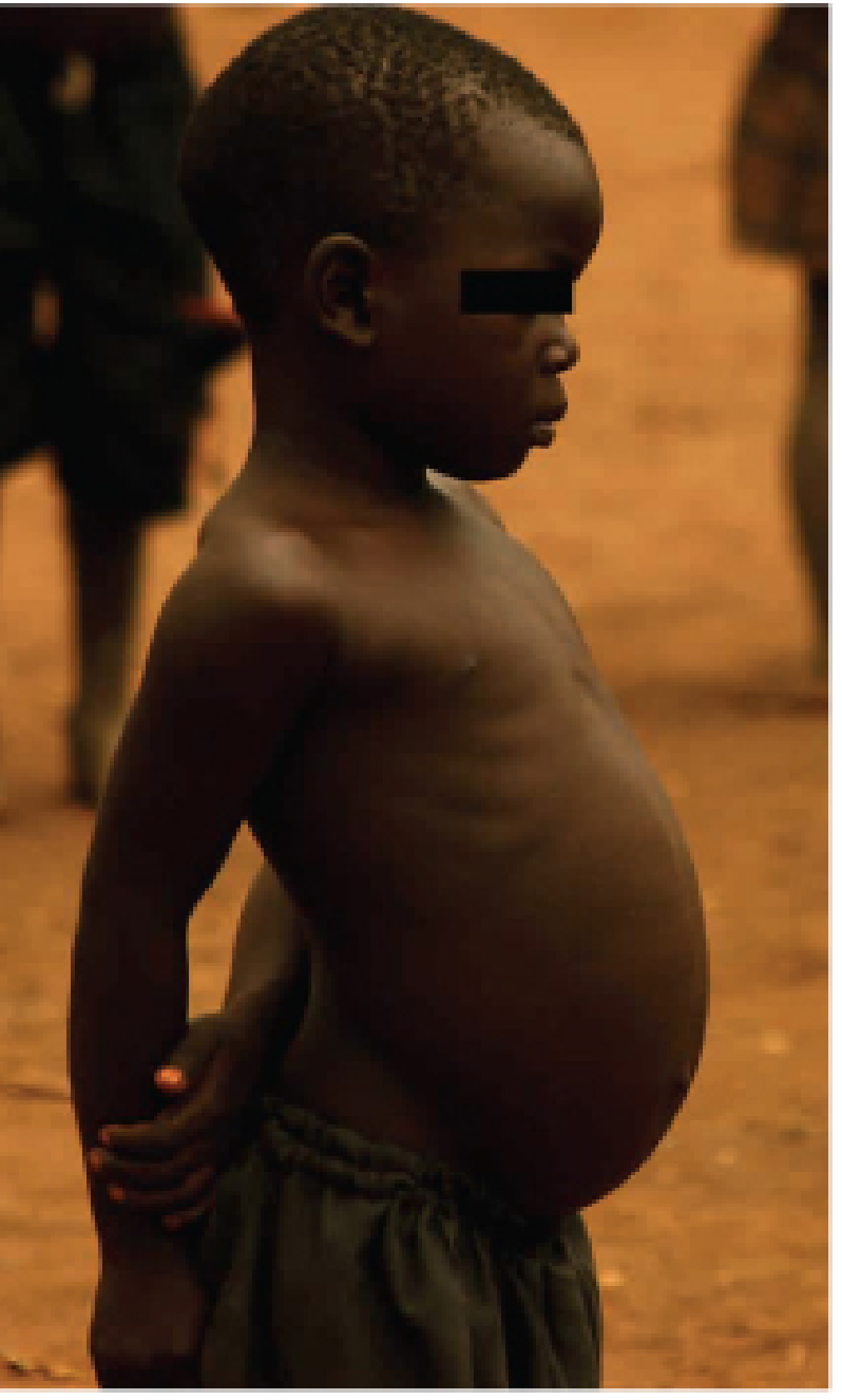 Child with kwashiorkor showing swollen abdomen and legs - classic bilateral pitting oedema