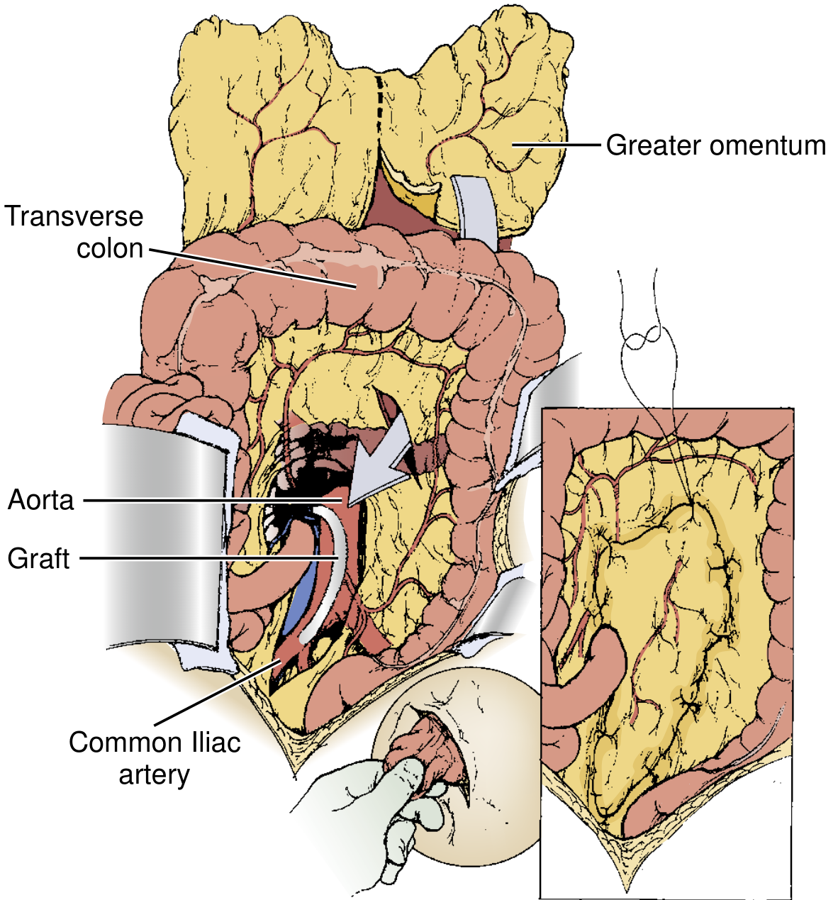 FIG. 6 — Omental pedicle flap