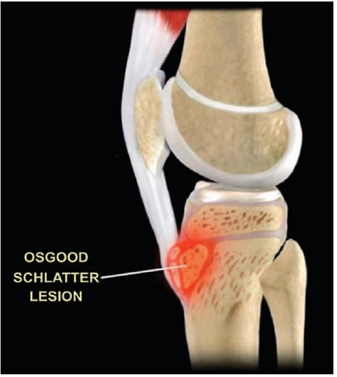 Osgood-Schlatter lesion anatomy