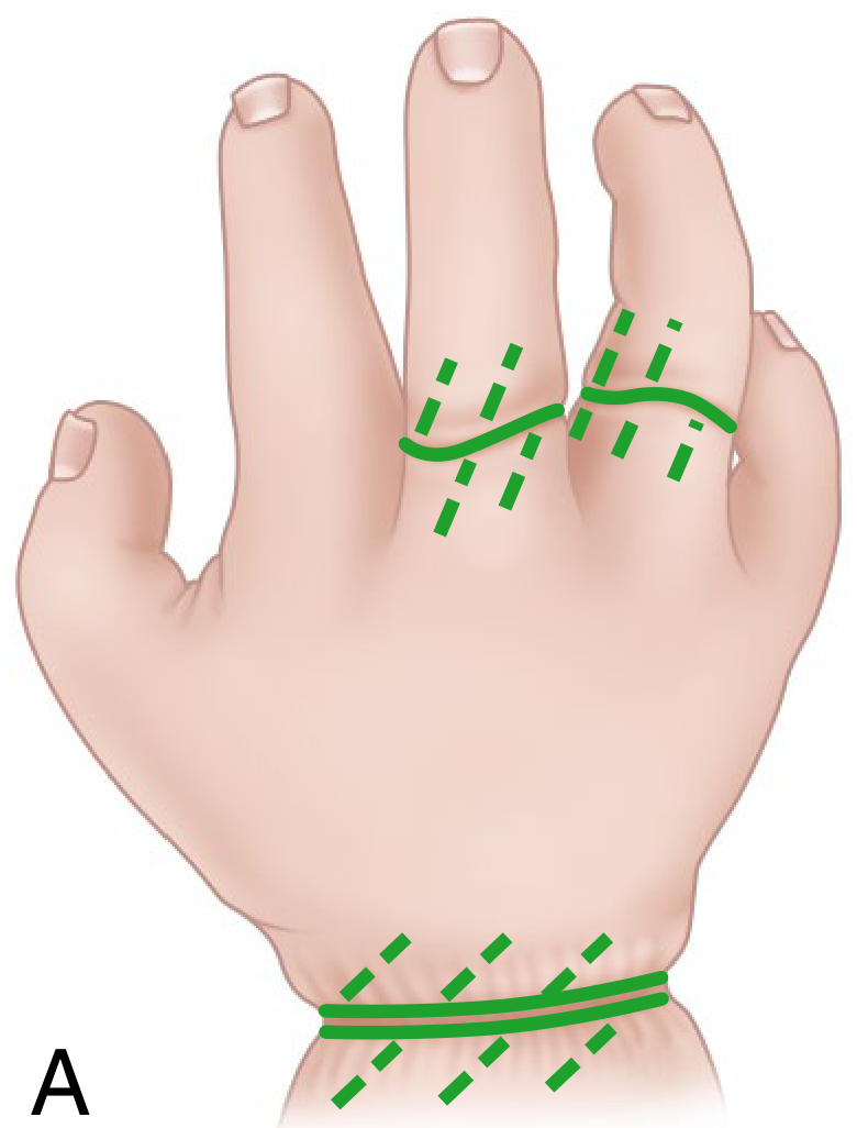 Diagram showing constriction ring Z-plasty incision planning on the hand and wrist