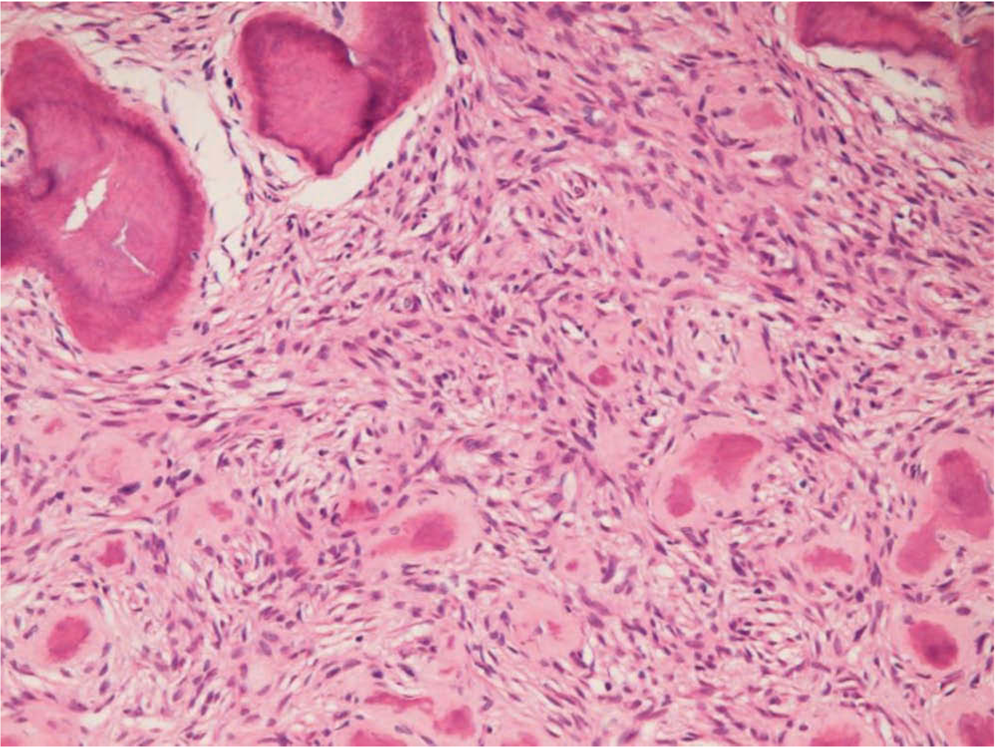 Ossifying fibroma / fibro-osseous lesion histopathology