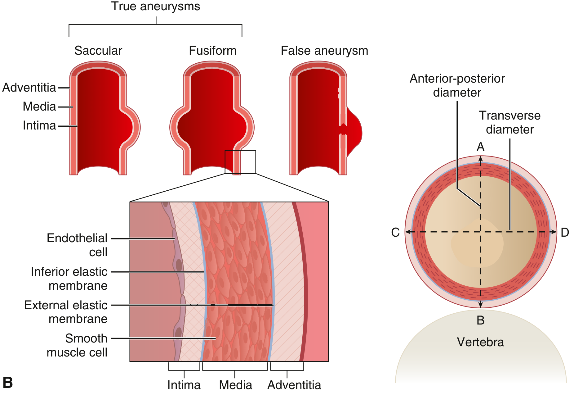Types of aneurysms and aortic wall layers - Goldman-Cecil Medicine