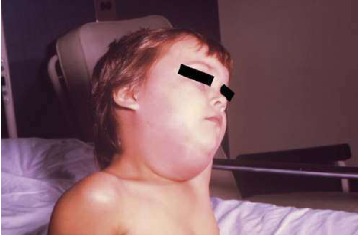 Mumps parotitis - submandibular swelling in a child