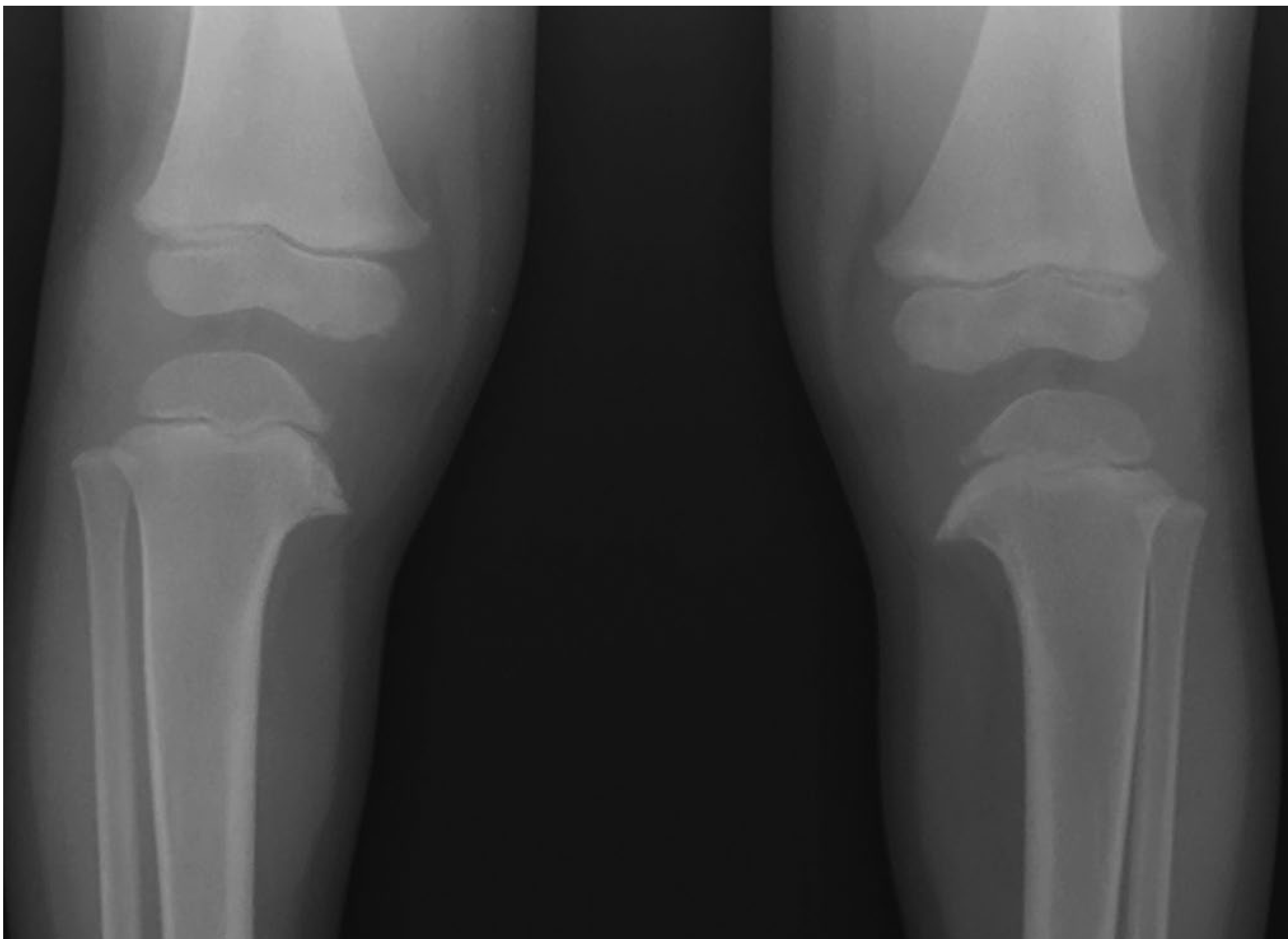 X-ray tibia vara - bilateral proximal tibial epiphyseal changes
