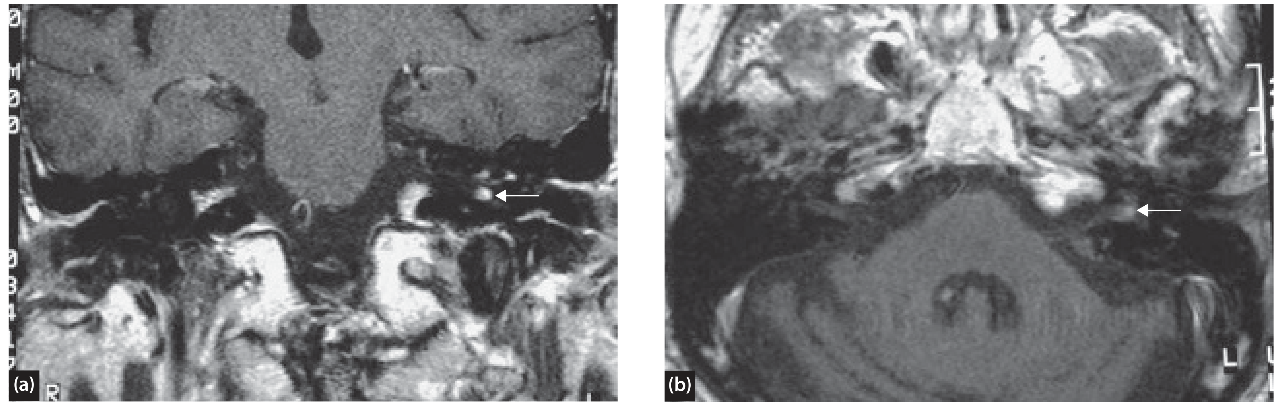 Bell's palsy MRI: coronal (a) and axial (b) T1+Gad showing increased signal in the geniculate region (arrows) - asymmetric, diffuse, linear enhancement