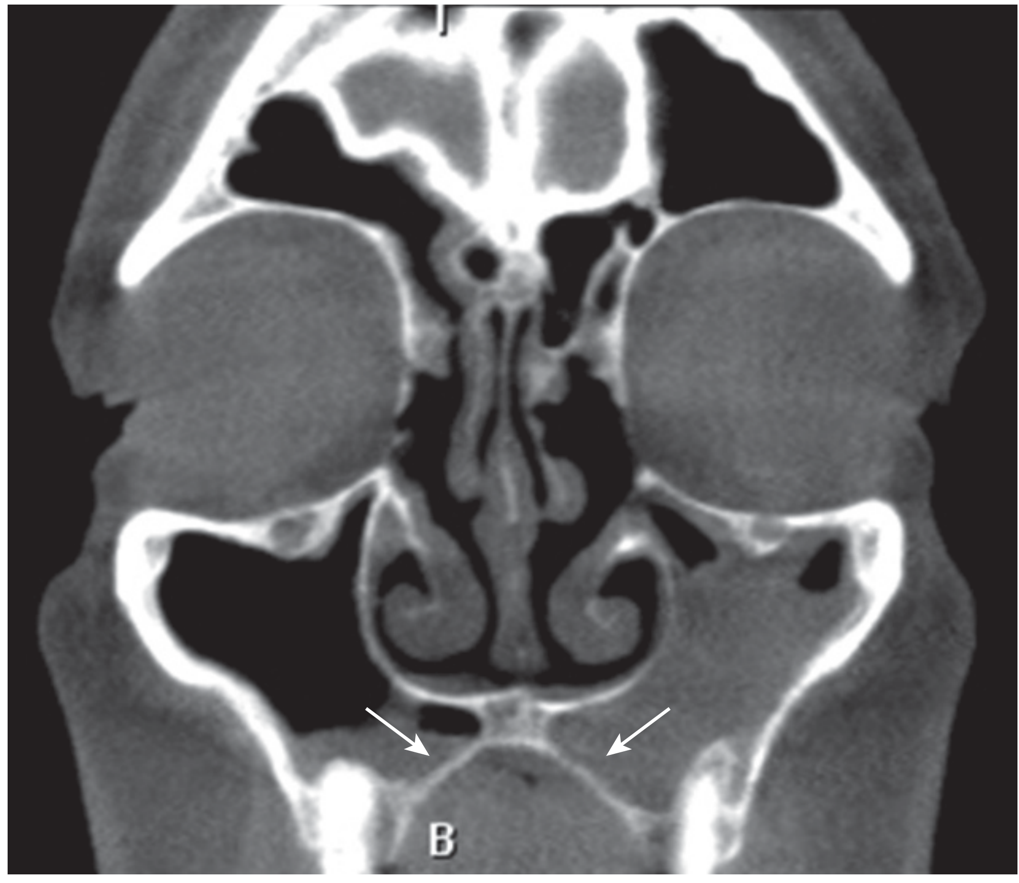 Coronal CT maxillary sinus - extensive pneumatization into hard palate with arrows