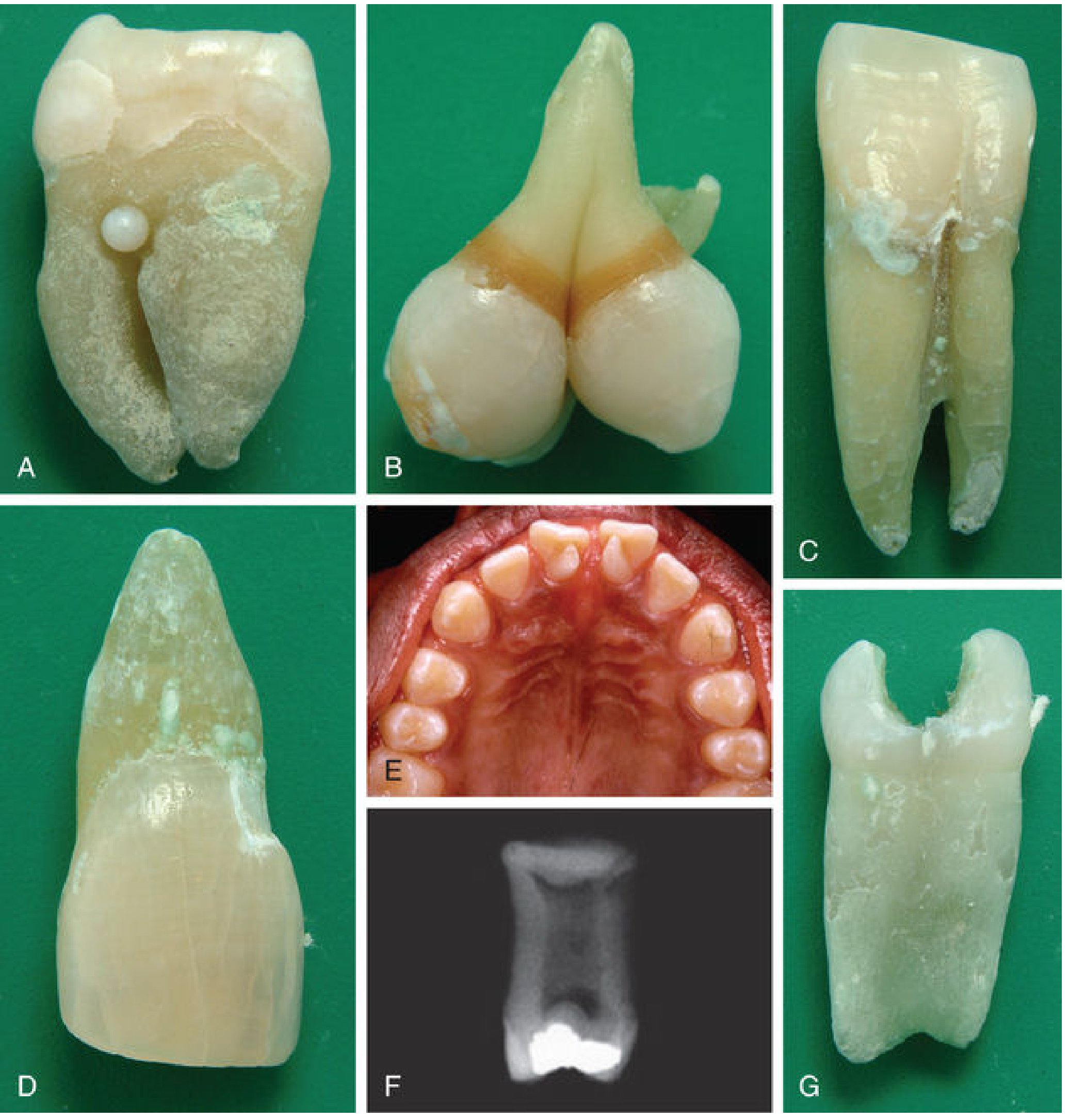 Common dental anomalies including fusion of permanent mandibular central and lateral incisors (panel C) and primary mandibular incisors (panel G)
