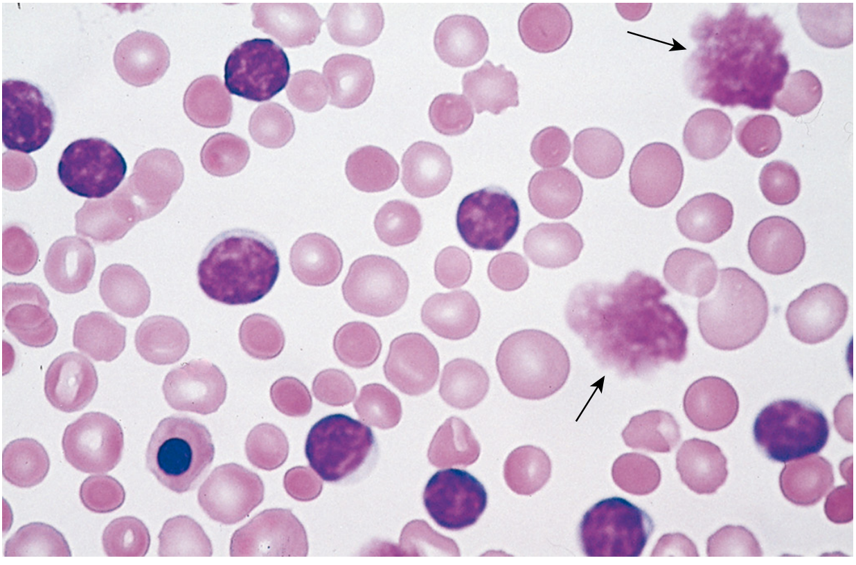 CLL peripheral blood smear showing small lymphocytes and smudge cells