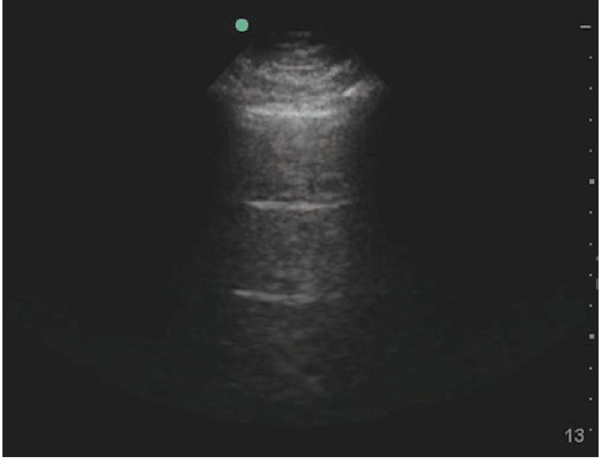 A-lines: equidistant horizontal reverberation artifacts from the pleural surface