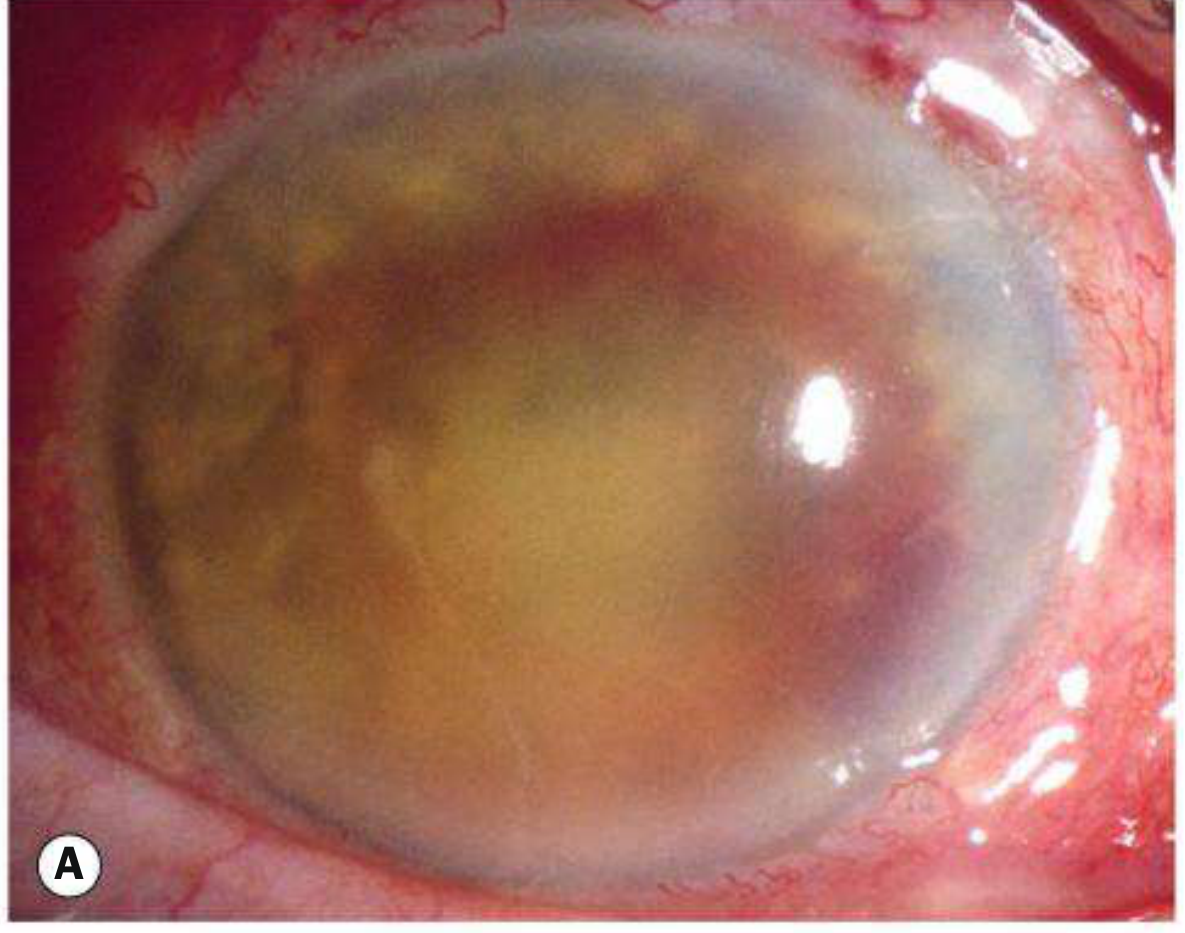 Endophthalmitis - severe anterior chamber infection with fibrinous exudate - Kanski
