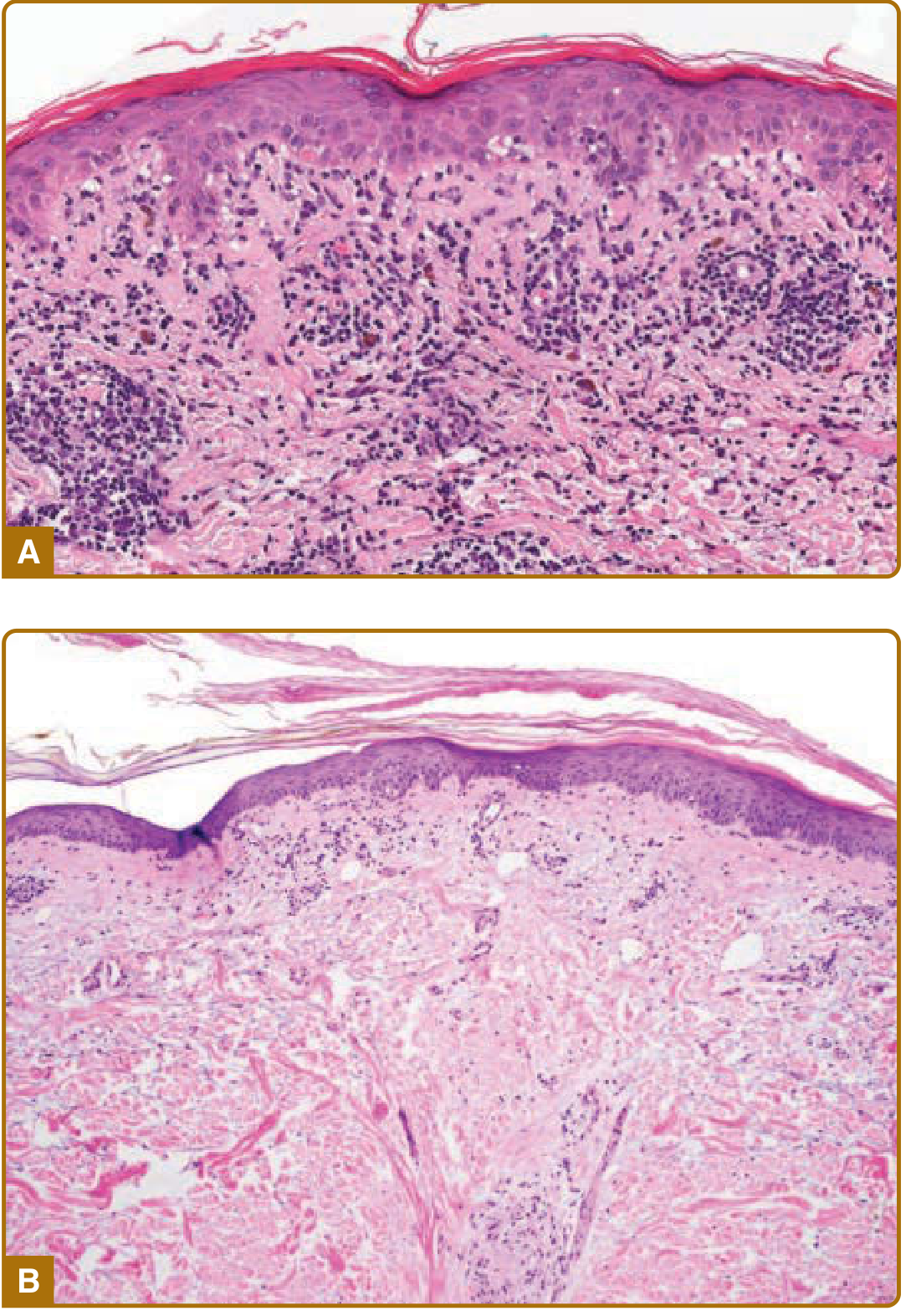 Histopathology of DLE - interface changes and dense deep infiltrate