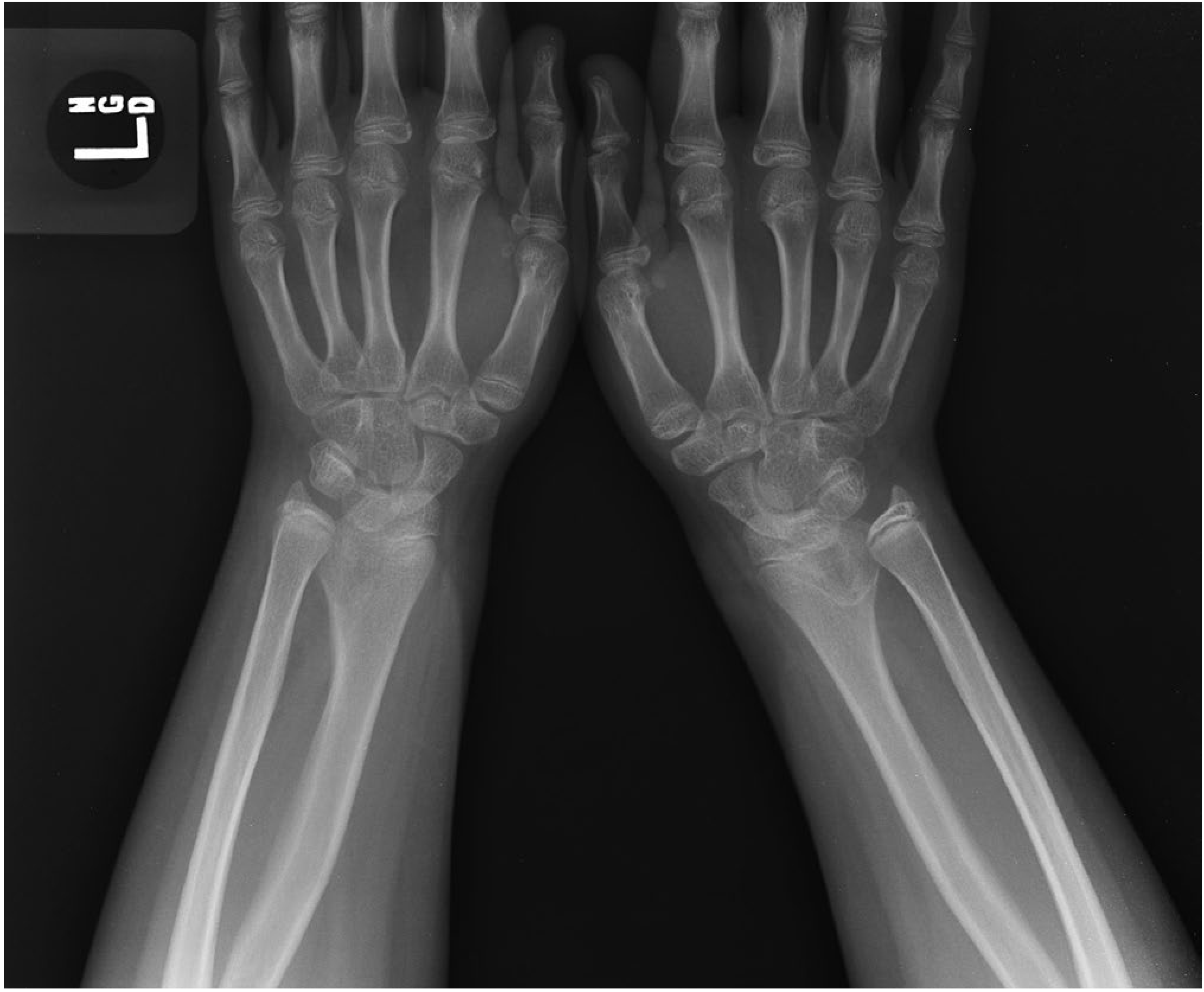 Bilateral Madelung deformity - PA radiograph showing volar-ulnar underdevelopment of the distal radius, increased radial inclination, and proximal immigration of the lunate bilaterally