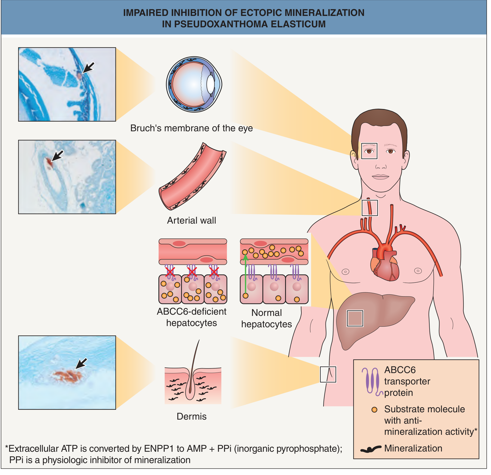 Impaired inhibition of ectopic mineralization in PXE — ABCC6-deficient hepatocytes fail to produce PPi, resulting in calcium deposits (alizarin red staining, arrows) in the dermis, arterial wall, and Bruch's membrane