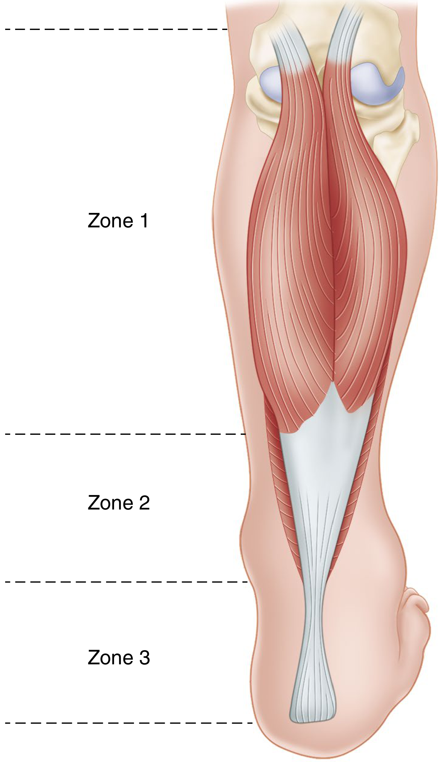 Three zones of the gastrocnemius-soleus complex
