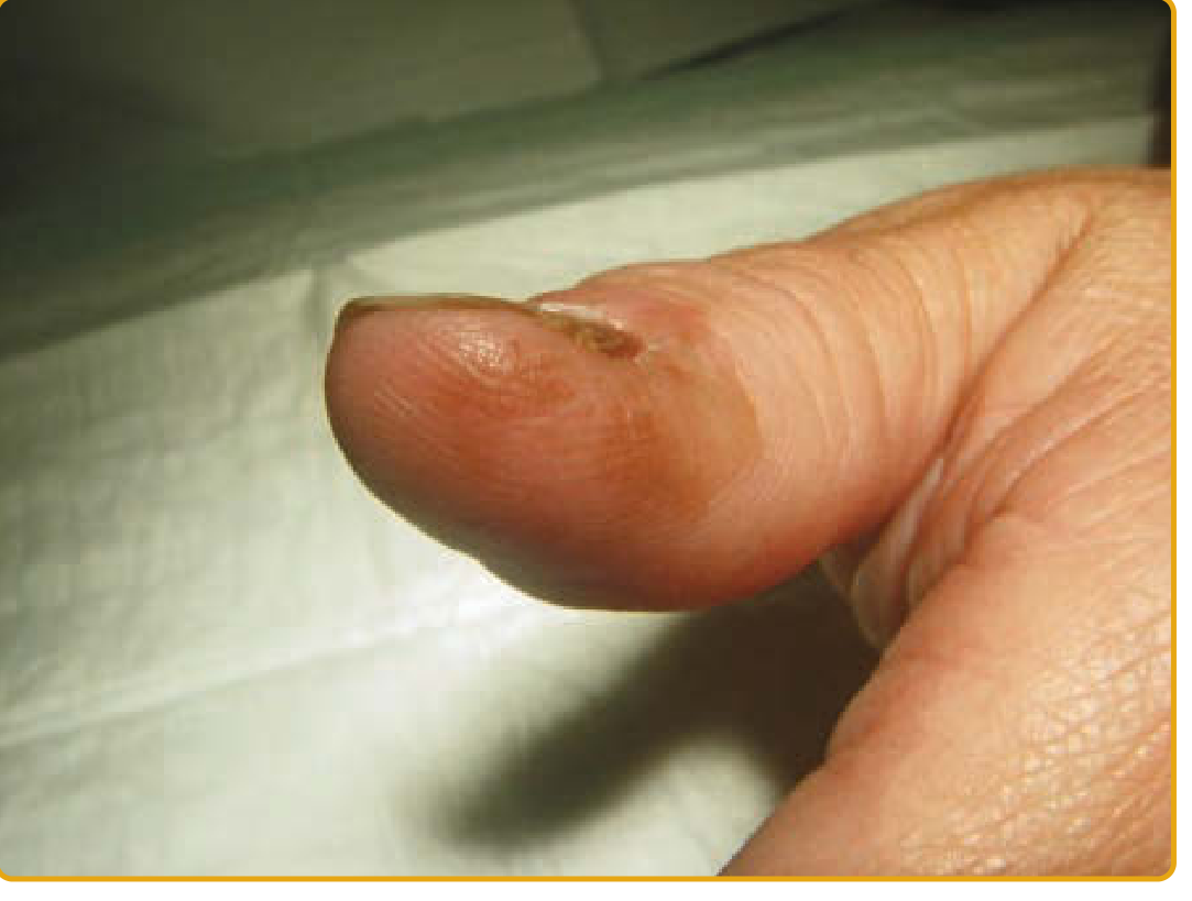 Subungual melanoma with Hutchinson sign - pigment spreading onto surrounding skin
