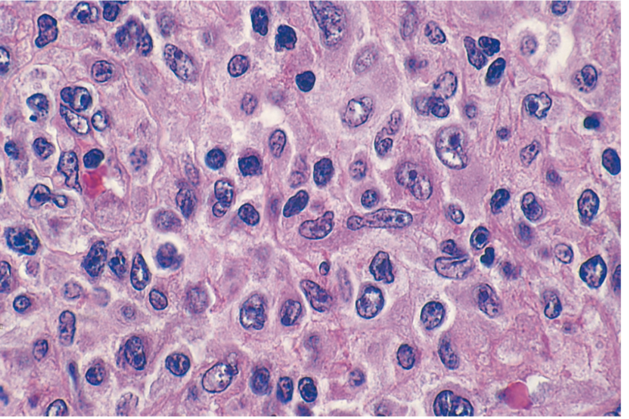 PTCL-NOS: Spectrum of small, intermediate, and large lymphoid cells, many with irregular nuclear contours