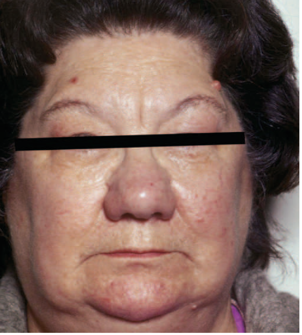 Facial appearance in hypothyroidism showing puffy eyes and thickened skin
