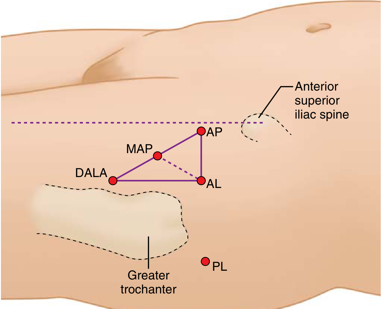 Portal positions for hip arthroscopy showing AL, MAP, DALA, AP, and PL portals relative to the greater trochanter and anterior superior iliac spine