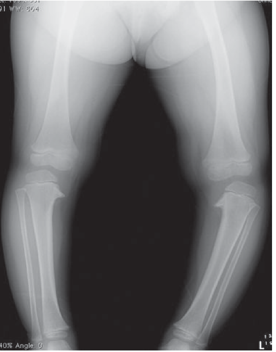 Bilateral Blount's disease - standing leg radiograph
