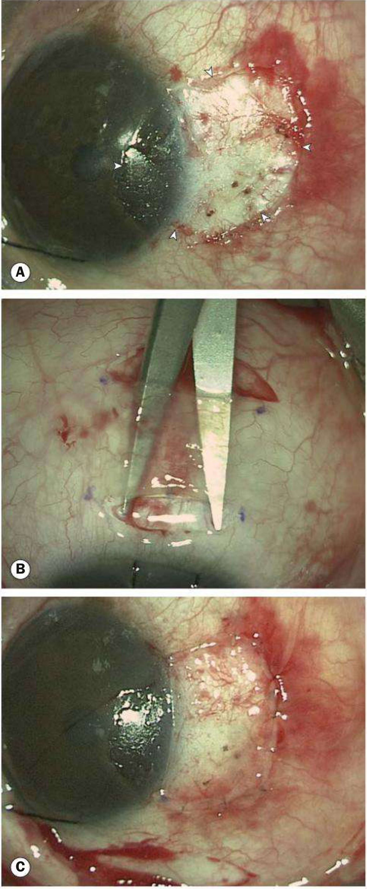 Surgical treatment of pterygium: (A) removal of pterygium head showing edges of incision; (B) preparation of conjunctival autograft; (C) graft sutured into position