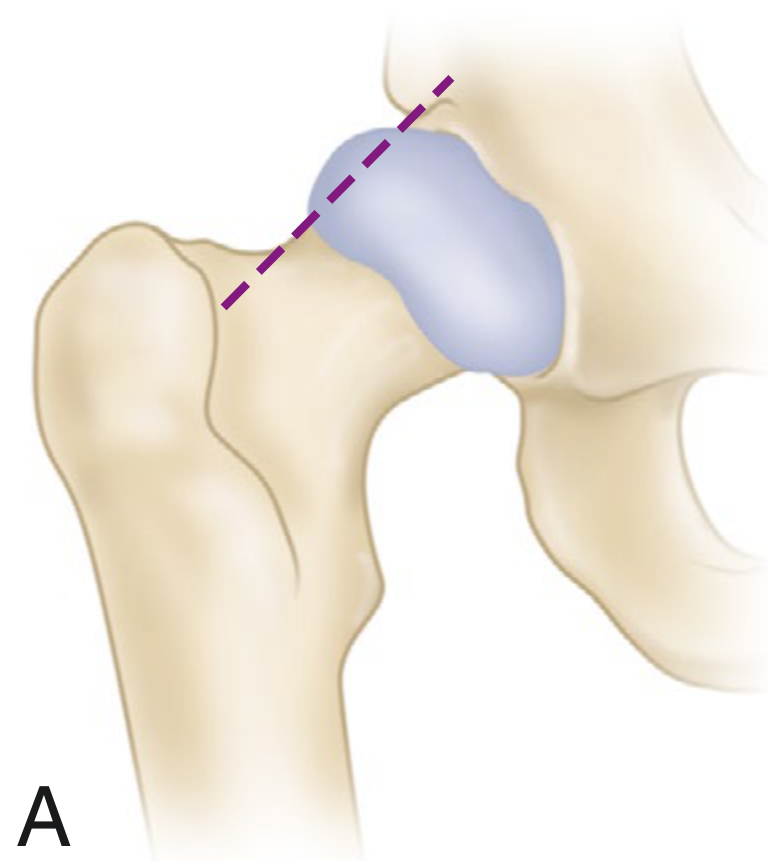 Klein's line - Normal hip (A): dashed line intersects the femoral head epiphysis. In SCFE the line passes superior to the head.
