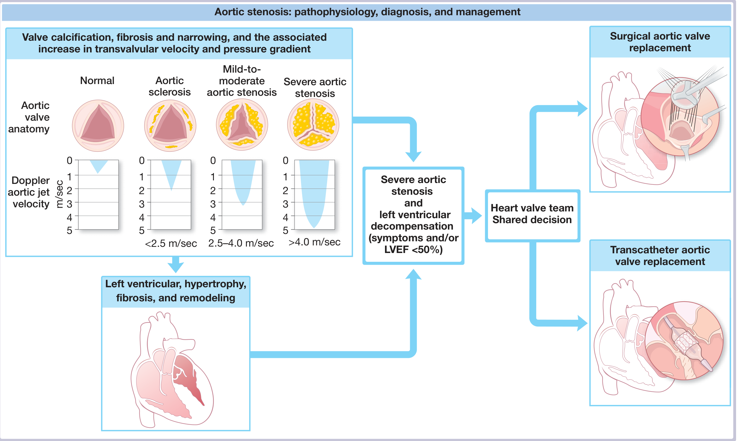 Natural history of aortic stenosis - comprehensive diagram showing progression from normal to severe AS with Doppler velocities, LV hypertrophy/fibrosis/remodeling, and management options