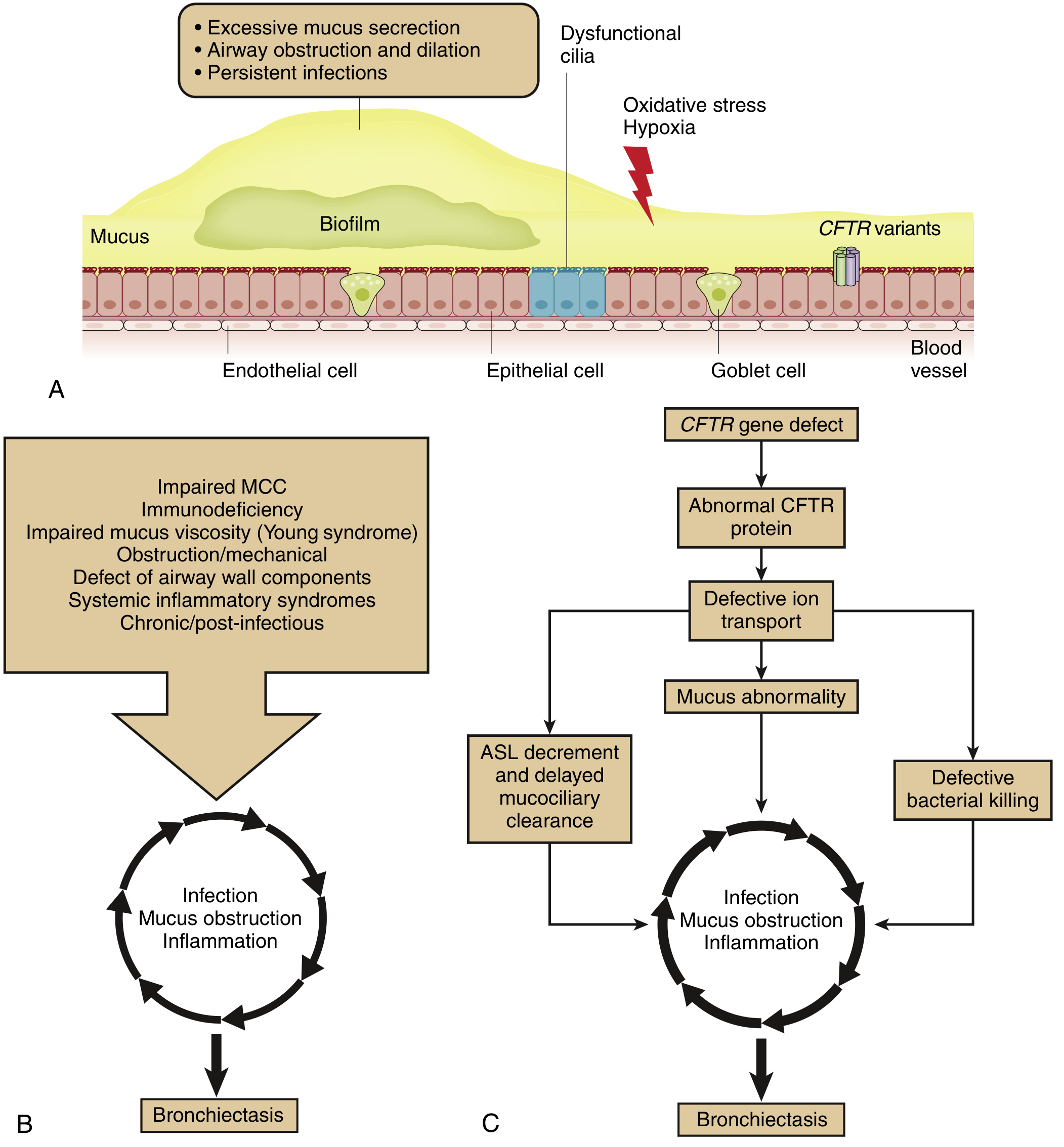 General pathophysiologic mechanisms for bronchiectasis - vicious cycle diagram (Murray & Nadel's)